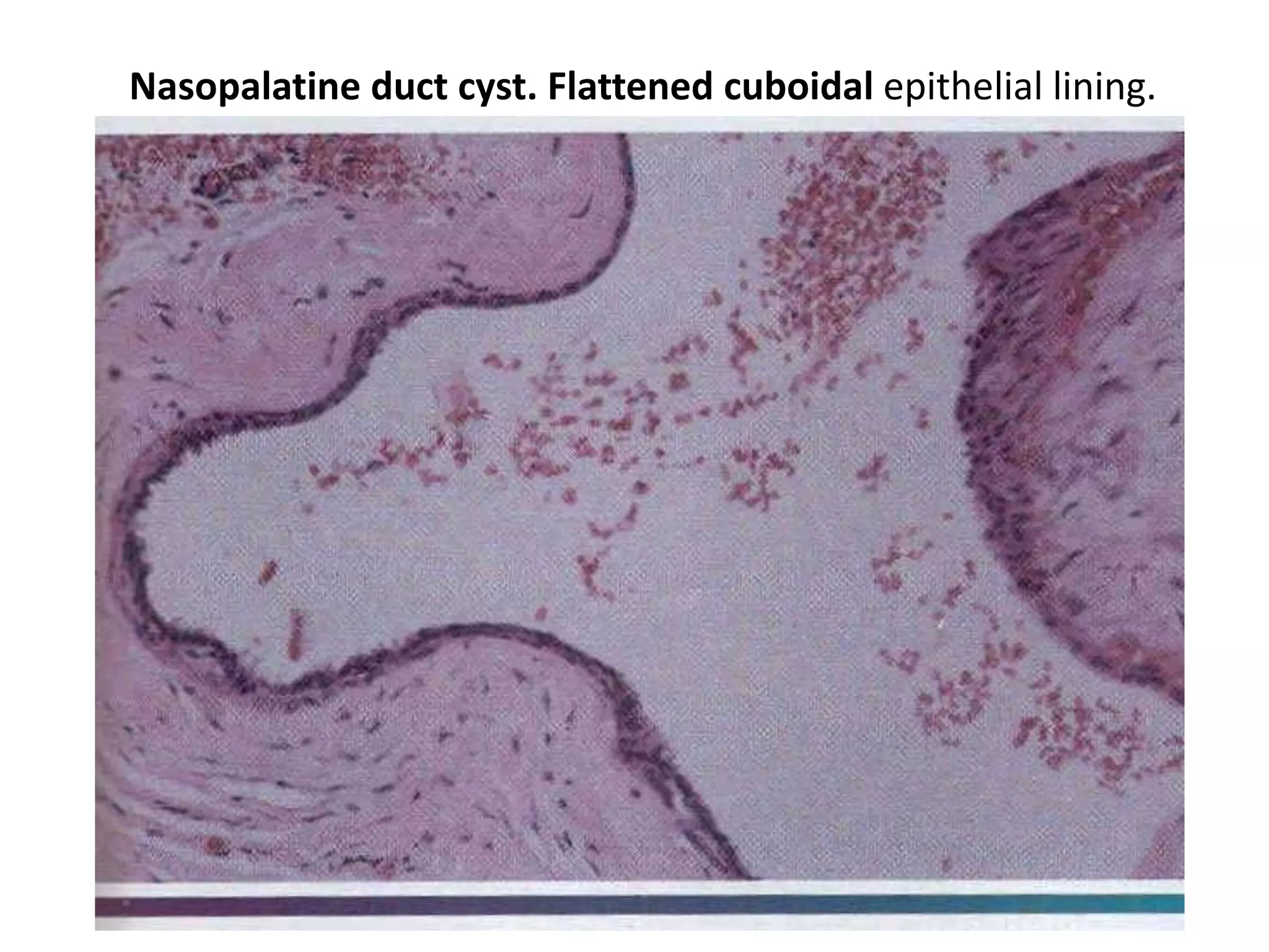 Nasopalatine duct cyst. Flattened cuboidal epithelial lining.
 