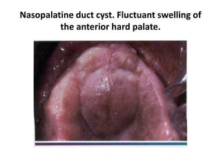 Nasopalatine duct cyst. Fluctuant swelling of
the anterior hard palate.
 