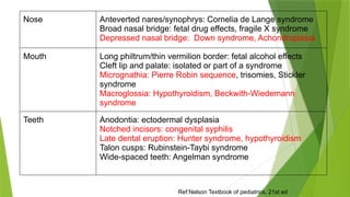 Ref:Nelson Textbook of pediatrics, 21st ed
Nose Anteverted nares/synophrys: Cornelia de Lange syndrome
Broad nasal bridge: fetal drug effects, fragile X syndrome
Depressed nasal bridge: Down syndrome, Achondroplasia
Mouth Long philtrum/thin vermilion border: fetal alcohol effects
Cleft lip and palate: isolated or part of a syndrome
Micrognathia: Pierre Robin sequence, trisomies, Stickler
syndrome
Macroglossia: Hypothyroidism, Beckwith-Wiedemann
syndrome
Teeth Anodontia: ectodermal dysplasia
Notched incisors: congenital syphilis
Late dental eruption: Hunter syndrome, hypothyroidism
Talon cusps: Rubinstein-Taybi syndrome
Wide-spaced teeth: Angelman syndrome
 