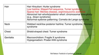 Ref:Nelson Textbook of pediatrics, 21st ed
Hair Hair Hirsutism: Hurler syndrome
Low hairline: Klippel-Feil sequence, Turner syndrome
Sparse hair: Menkes disease, argininosuccinic acidemia
Abnormal hair whorls/posterior whorl: chromosomal aneuploidy
(e.g., Down syndrome)
Abnormal eyebrow patterning: Cornelia de Lange syndrome
Neck Webbed neck/low posterior hairline: Turner syndrome, Noonan
syndrome
Chest Shield-shaped chest: Turner syndrome
Genitalia Macroorchidism: Fragile X syndrome
Hypogonadism: Prader-Willi syndrome
 
