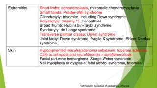 Extremities Short limbs: achondroplasia, rhizomelic chondrodysplasia
Small hands: Prader-Willi syndrome
Clinodactyly: trisomies, including Down syndrome
Polydactyly: trisomy 13, ciliopathies
Broad thumb: Rubinstein-Taybi syndrome
Syndactyly: de Lange syndrome
Transverse palmar crease: Down syndrome
Joint laxity: Down syndrome, fragile X syndrome, Ehlers-Danlos
syndrome
Skin Hypopigmented macules/adenoma sebaceum: tuberous sclerosis
Café au lait spots and neurofibromas: neurofibromatosis
Facial port-wine hemangioma: Sturge-Weber syndrome
Nail hypoplasia or dysplasia: fetal alcohol syndrome, trisomies
Ref:Nelson Textbook of pediatrics, 21st ed
 