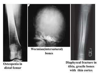 Osteopenia Tibia Developmental disorder of musculoskeletal system | PPTX