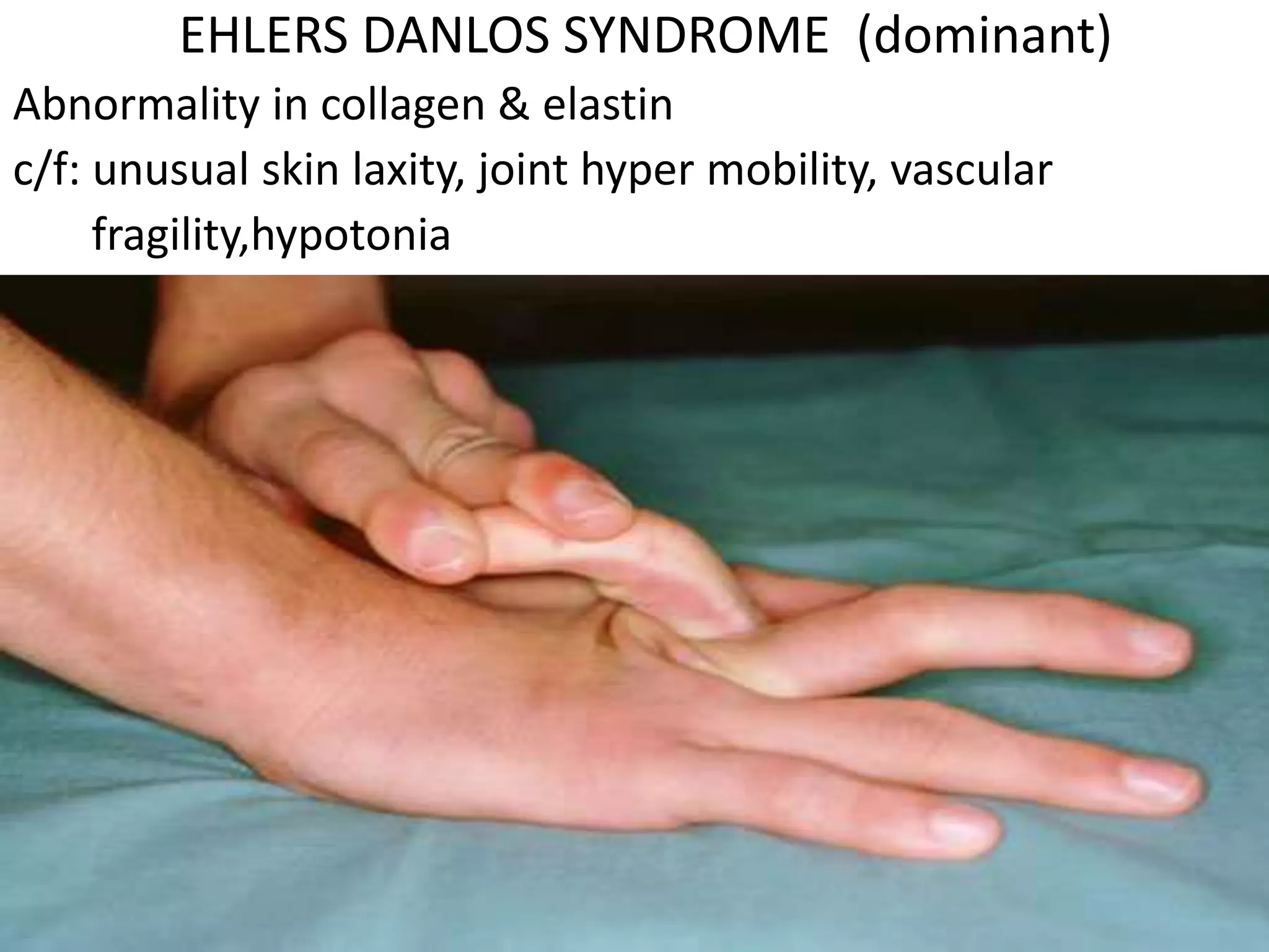 EHLERS DANLOS SYNDROME (dominant)
Abnormality in collagen & elastin
c/f: unusual skin laxity, joint hyper mobility, vascular
fragility,hypotonia
 