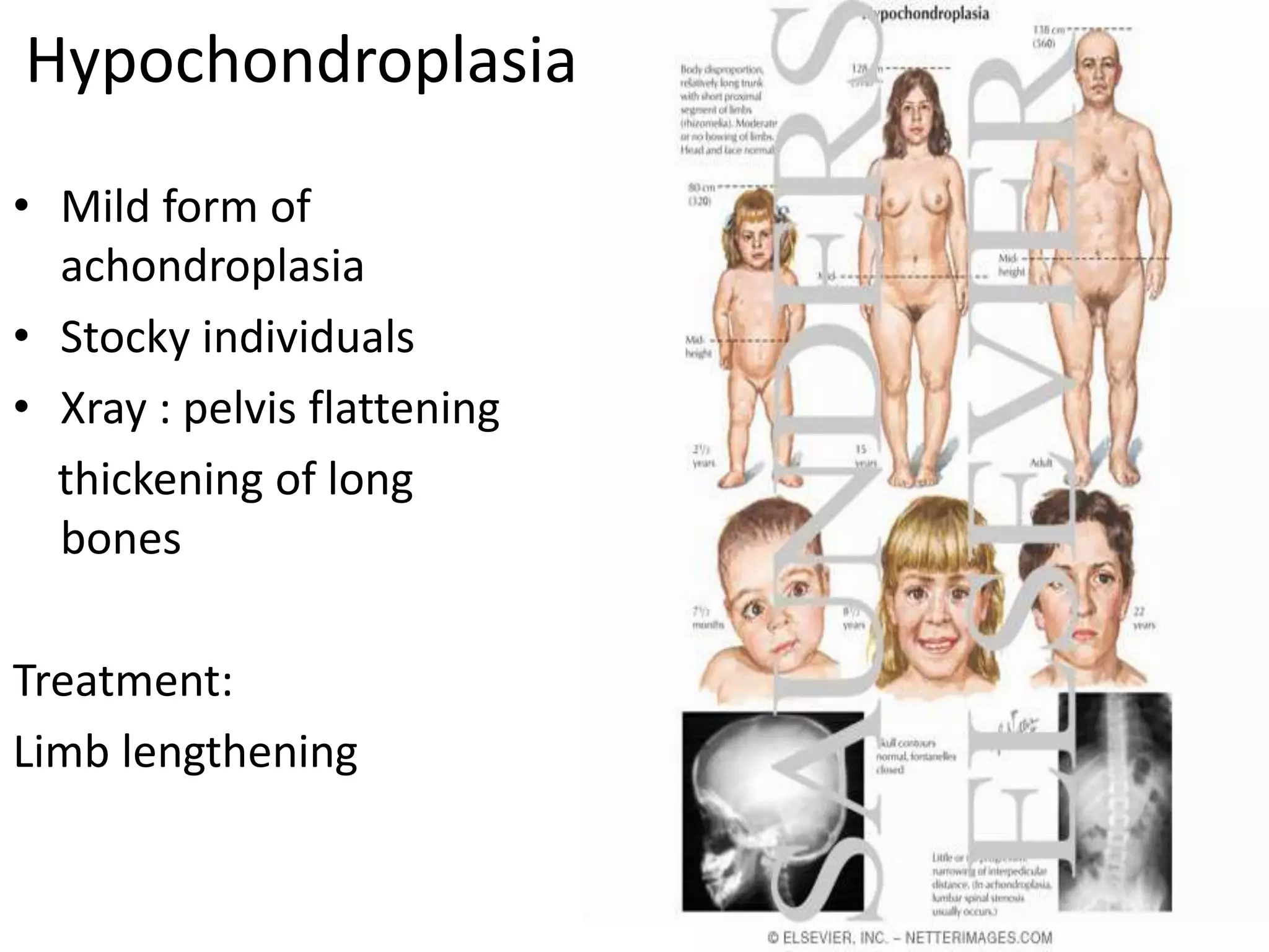 Hypochondroplasia
• Mild form of
achondroplasia
• Stocky individuals
• Xray : pelvis flattening
thickening of long
bones
Treatment:
Limb lengthening
 