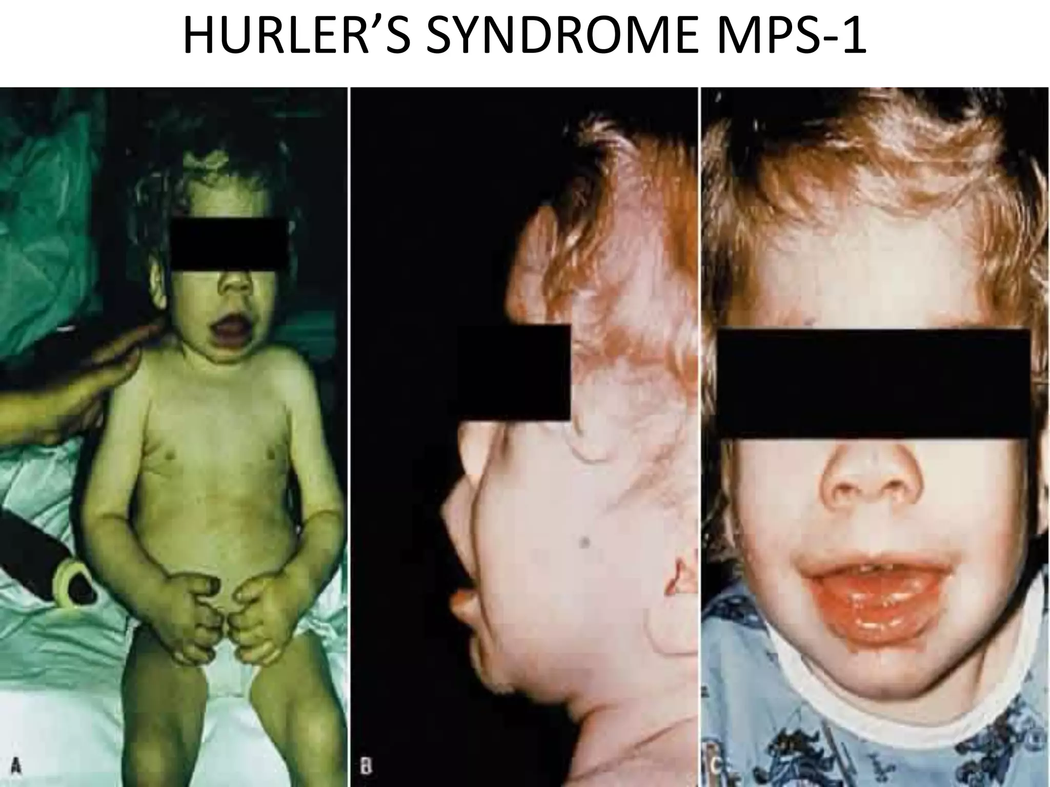 HURLER’S SYNDROME MPS-1
 
