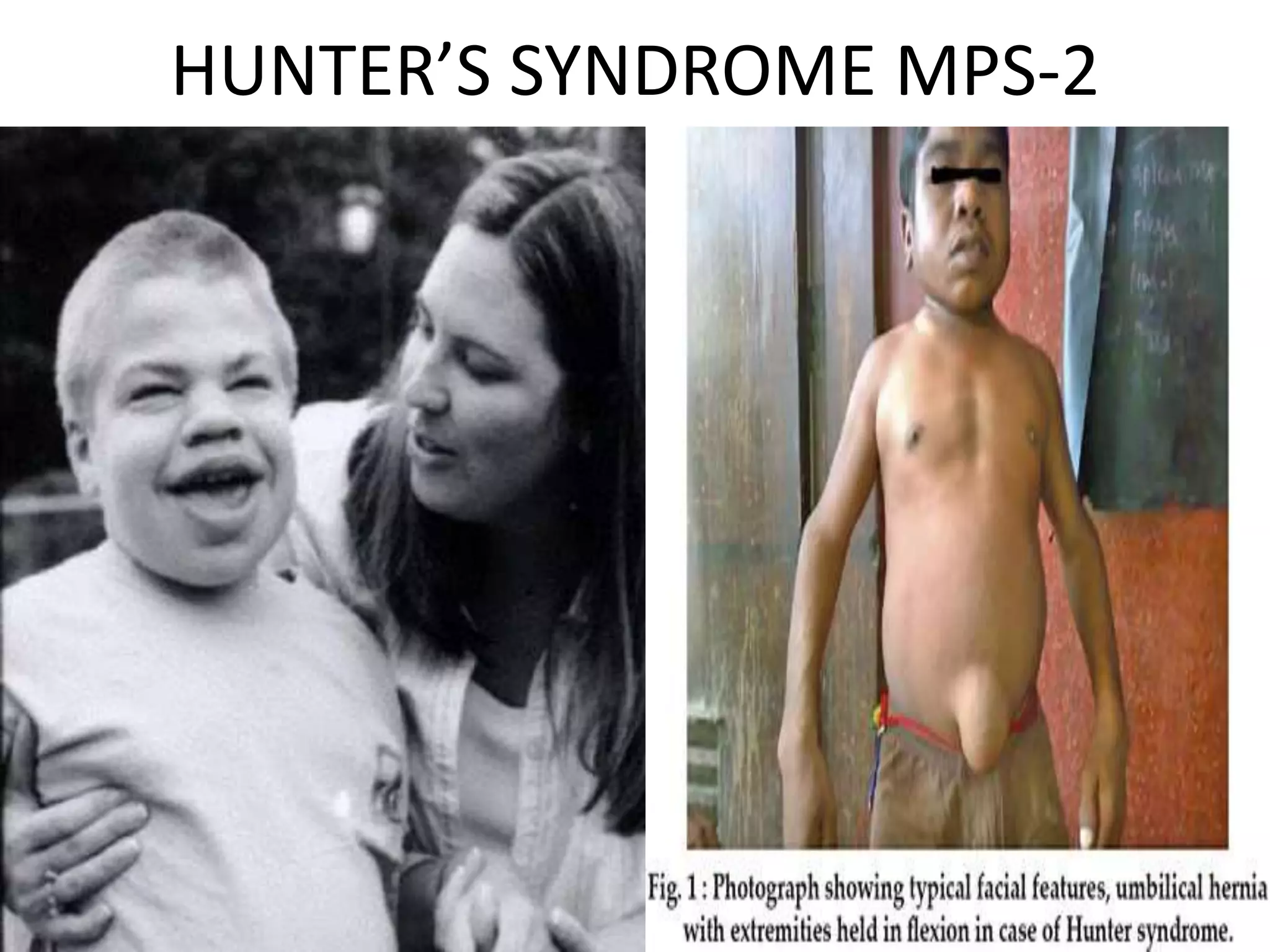 HUNTER’S SYNDROME MPS-2
 