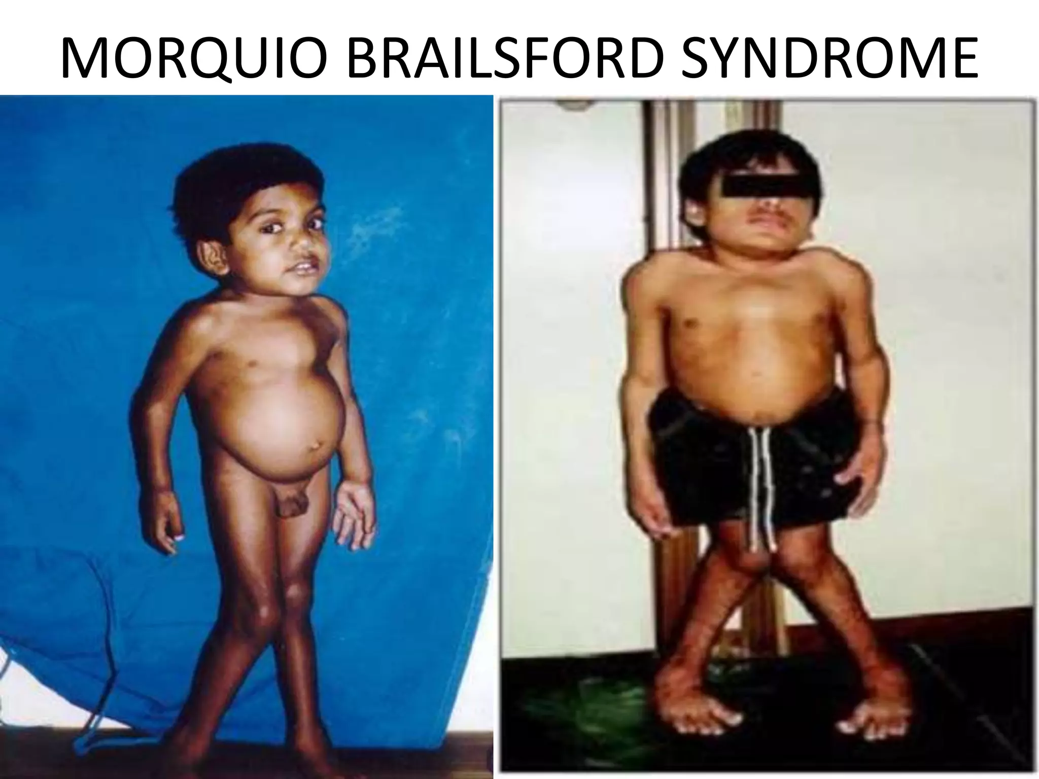 MORQUIO BRAILSFORD SYNDROME
 