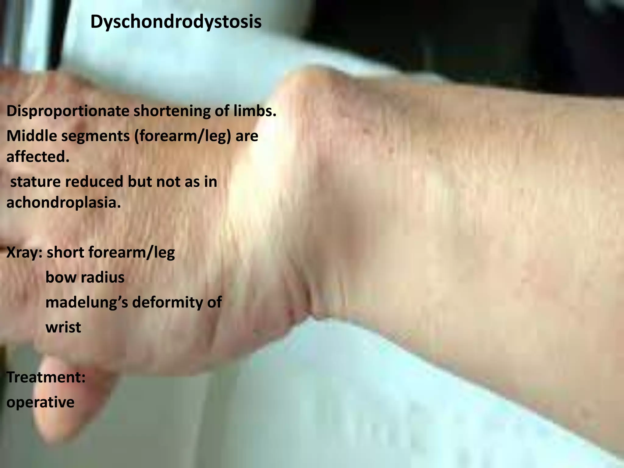 Dyschondrodystosis
Disproportionate shortening of limbs.
Middle segments (forearm/leg) are
affected.
stature reduced but not as in
achondroplasia.
Xray: short forearm/leg
bow radius
madelung’s deformity of
wrist
Treatment:
operative
 