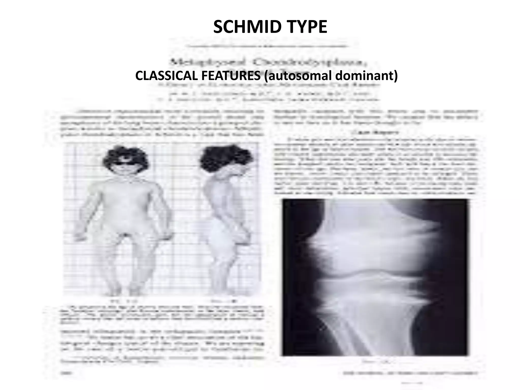 SCHMID TYPE
CLASSICAL FEATURES (autosomal dominant)
 
