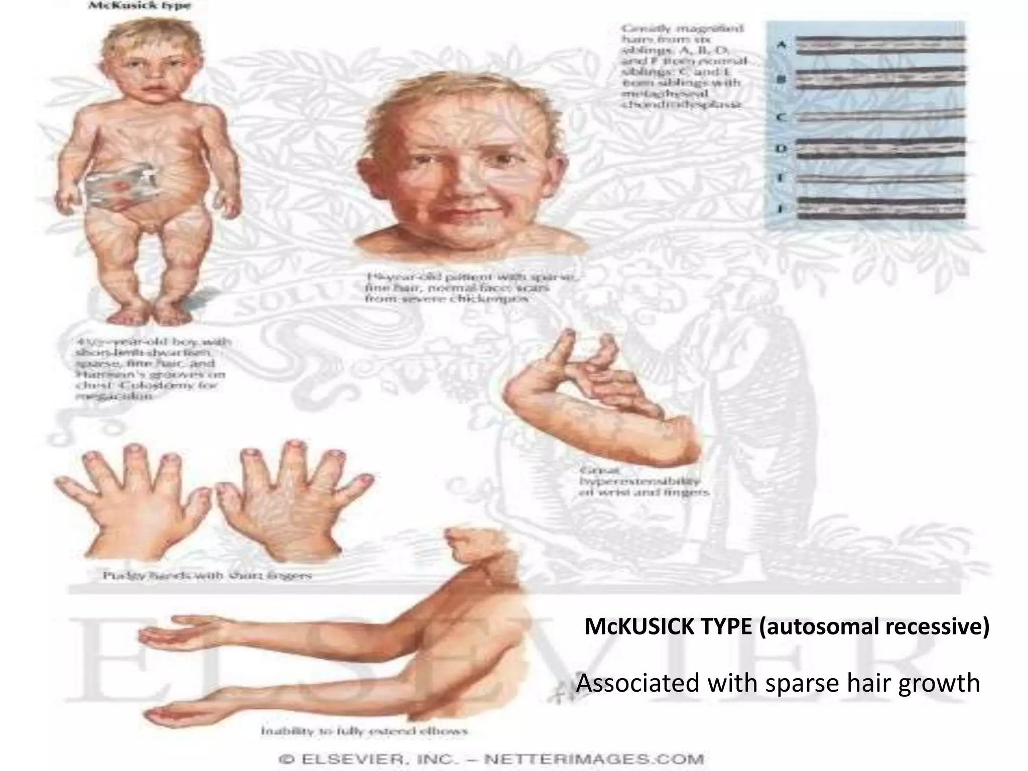 McKUSICK TYPE (autosomal recessive)
Associated with sparse hair growth
 