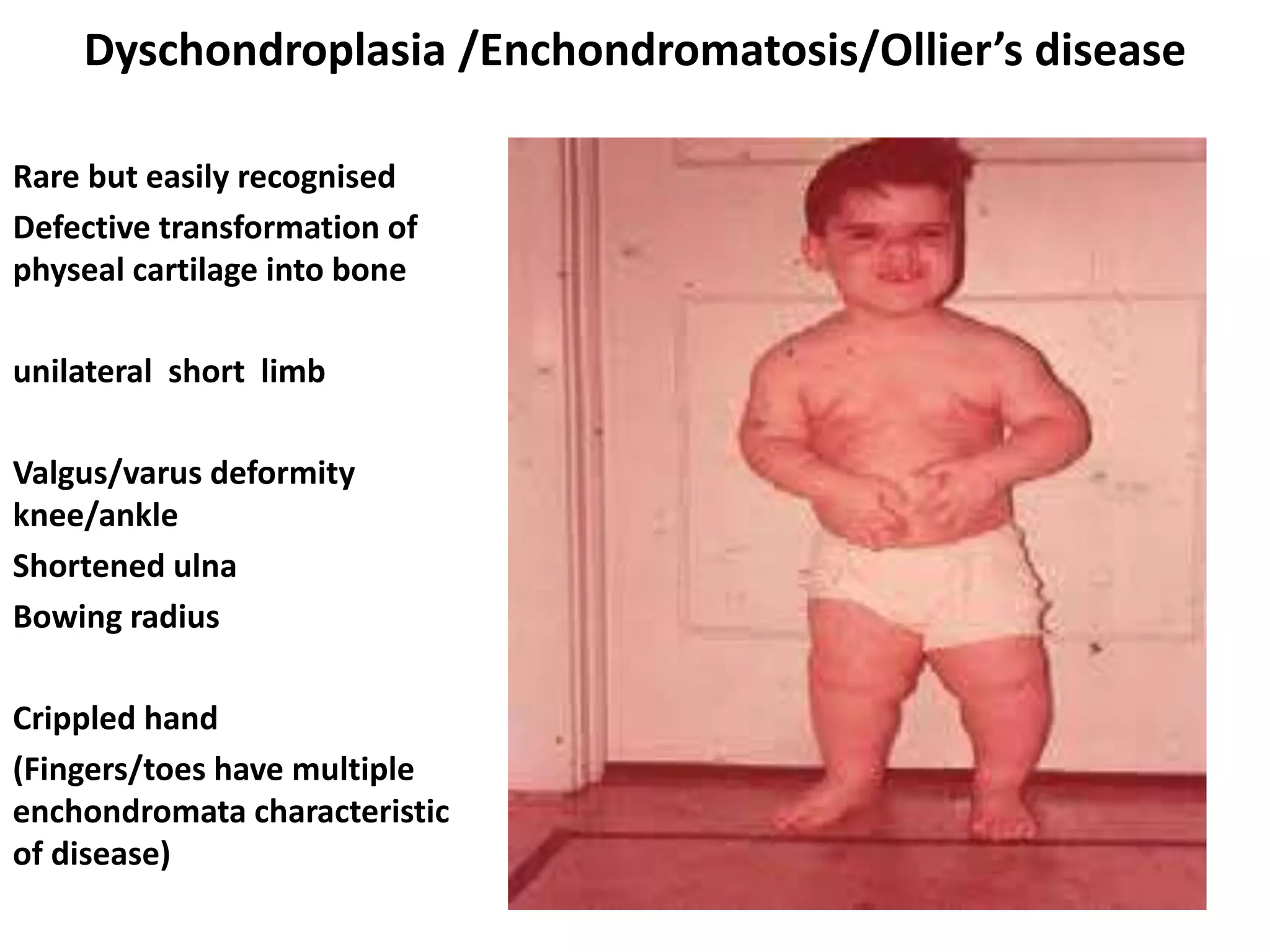 Dyschondroplasia /Enchondromatosis/Ollier’s disease
Rare but easily recognised
Defective transformation of
physeal cartilage into bone
unilateral short limb
Valgus/varus deformity
knee/ankle
Shortened ulna
Bowing radius
Crippled hand
(Fingers/toes have multiple
enchondromata characteristic
of disease)
 