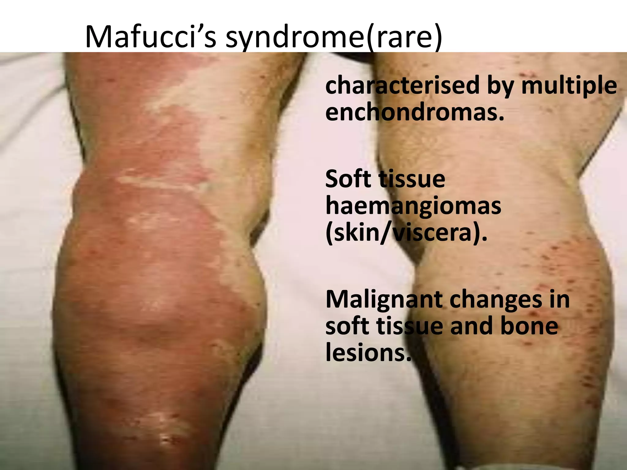 Mafucci’s syndrome(rare)
characterised by multiple
enchondromas.
Soft tissue
haemangiomas
(skin/viscera).
Malignant changes in
soft tissue and bone
lesions.
 