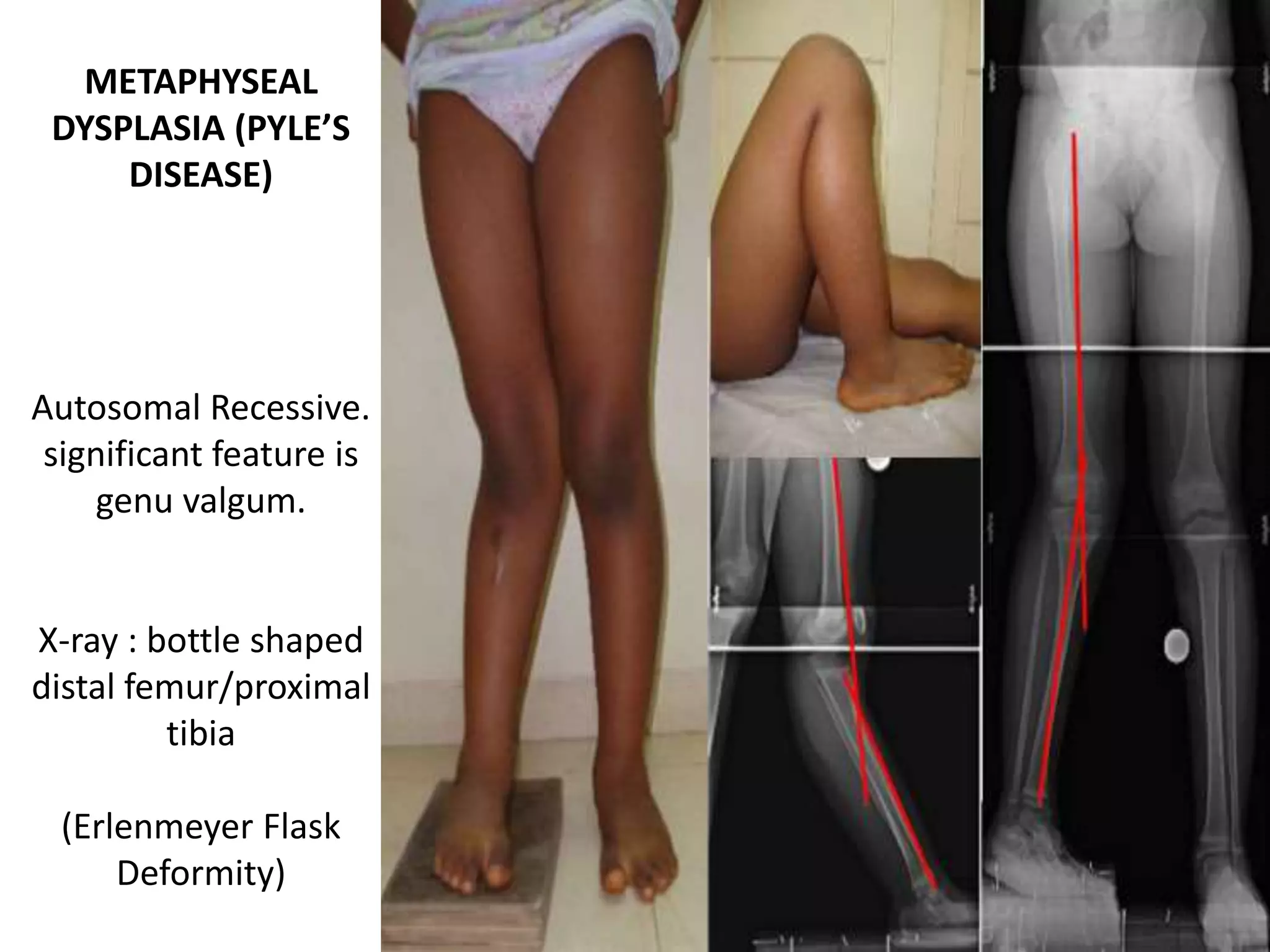 METAPHYSEAL
DYSPLASIA (PYLE’S
DISEASE)
Autosomal Recessive.
significant feature is
genu valgum.
X-ray : bottle shaped
distal femur/proximal
tibia
(Erlenmeyer Flask
Deformity)
 