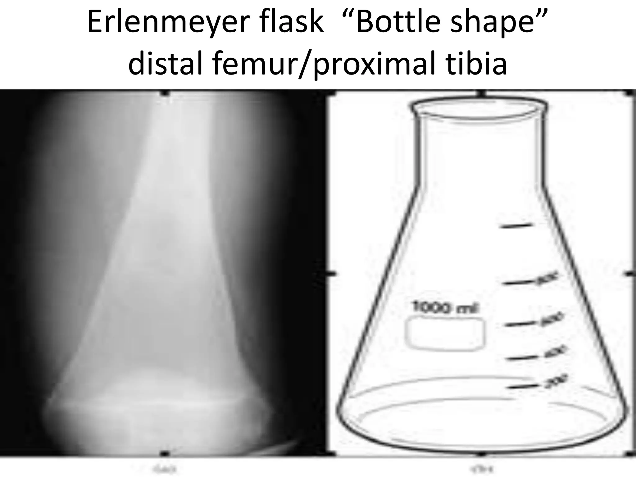 Erlenmeyer flask “Bottle shape”
distal femur/proximal tibia
 
