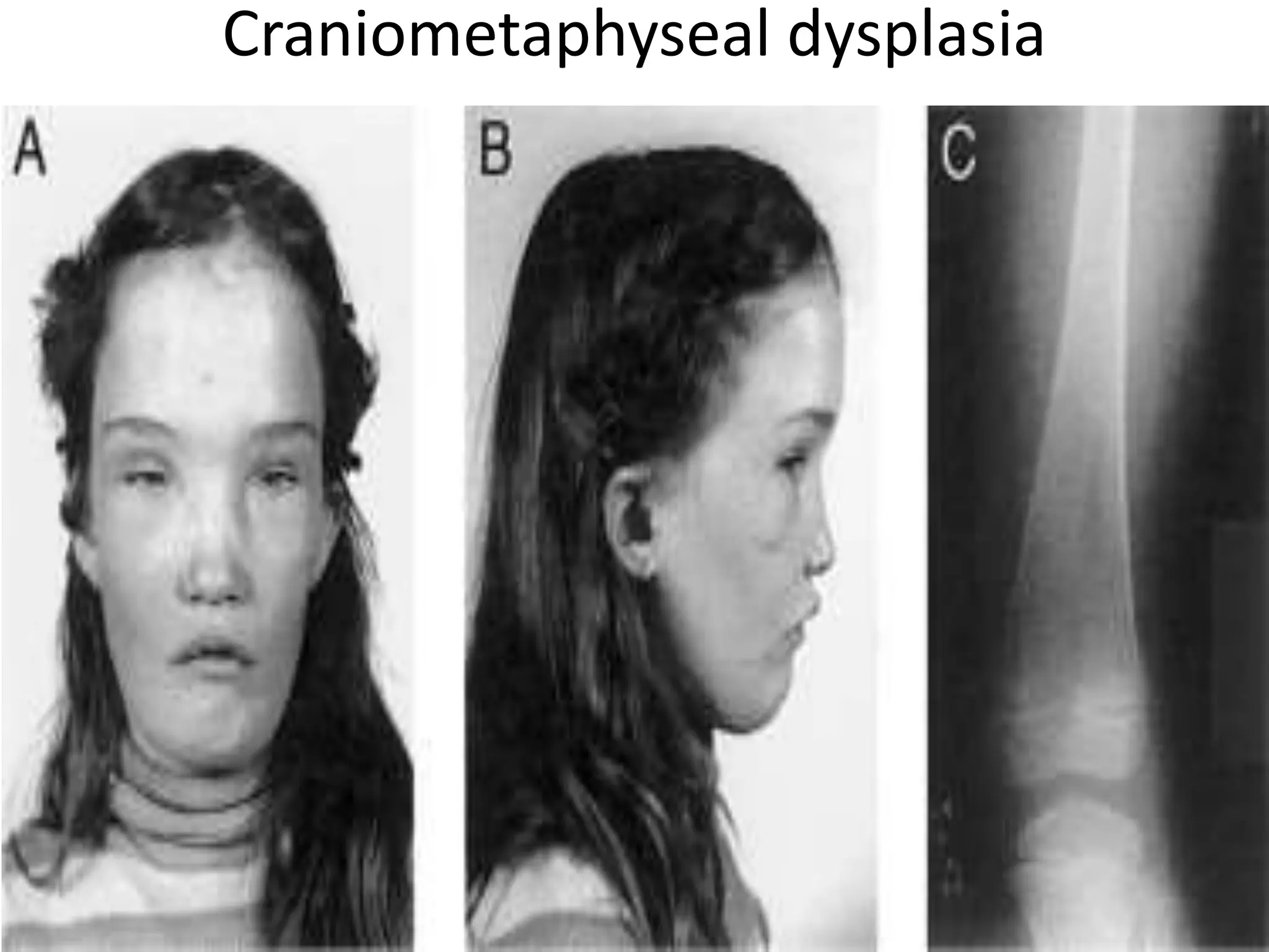 Craniometaphyseal dysplasia
 