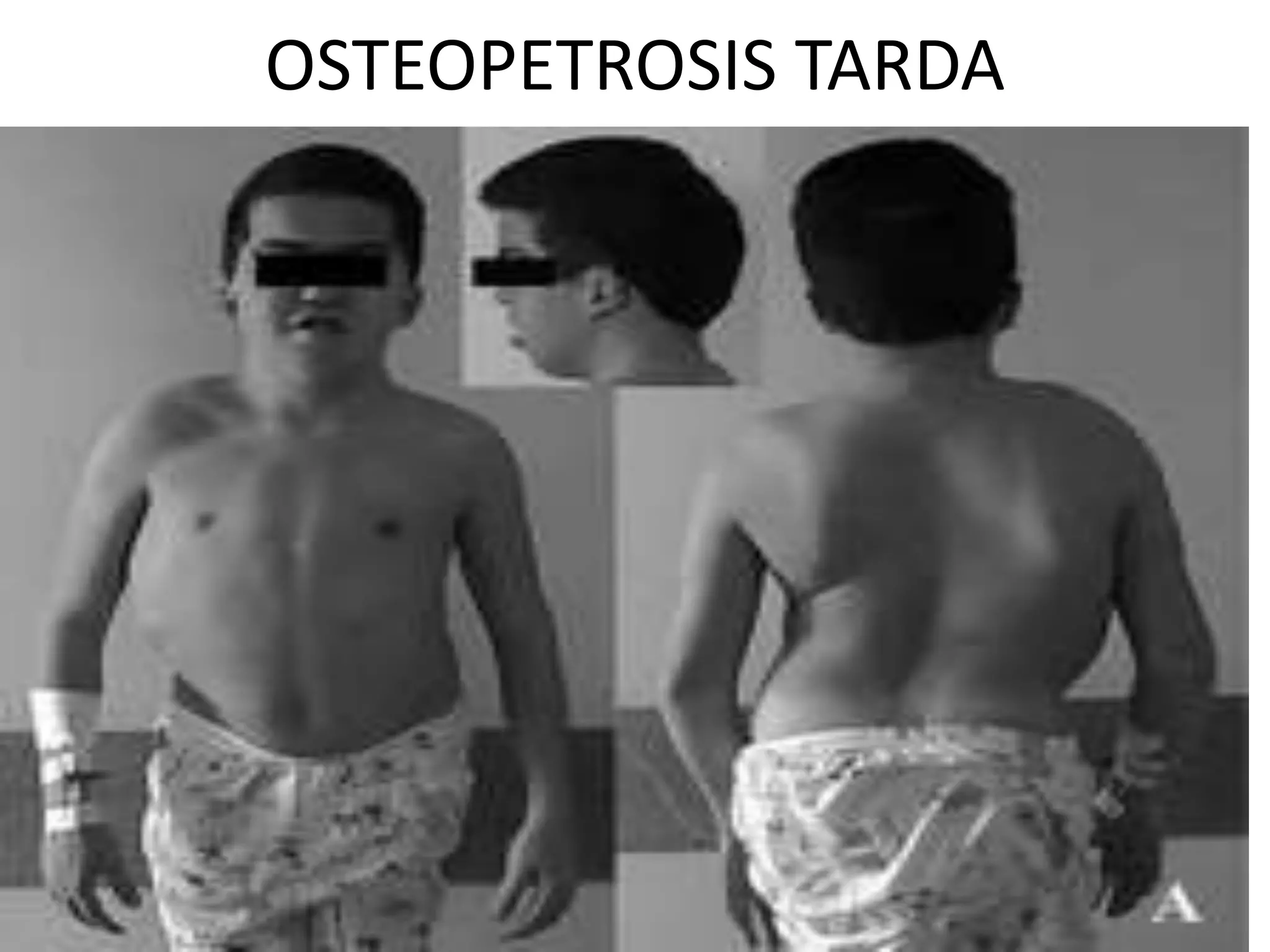 OSTEOPETROSIS TARDA
 