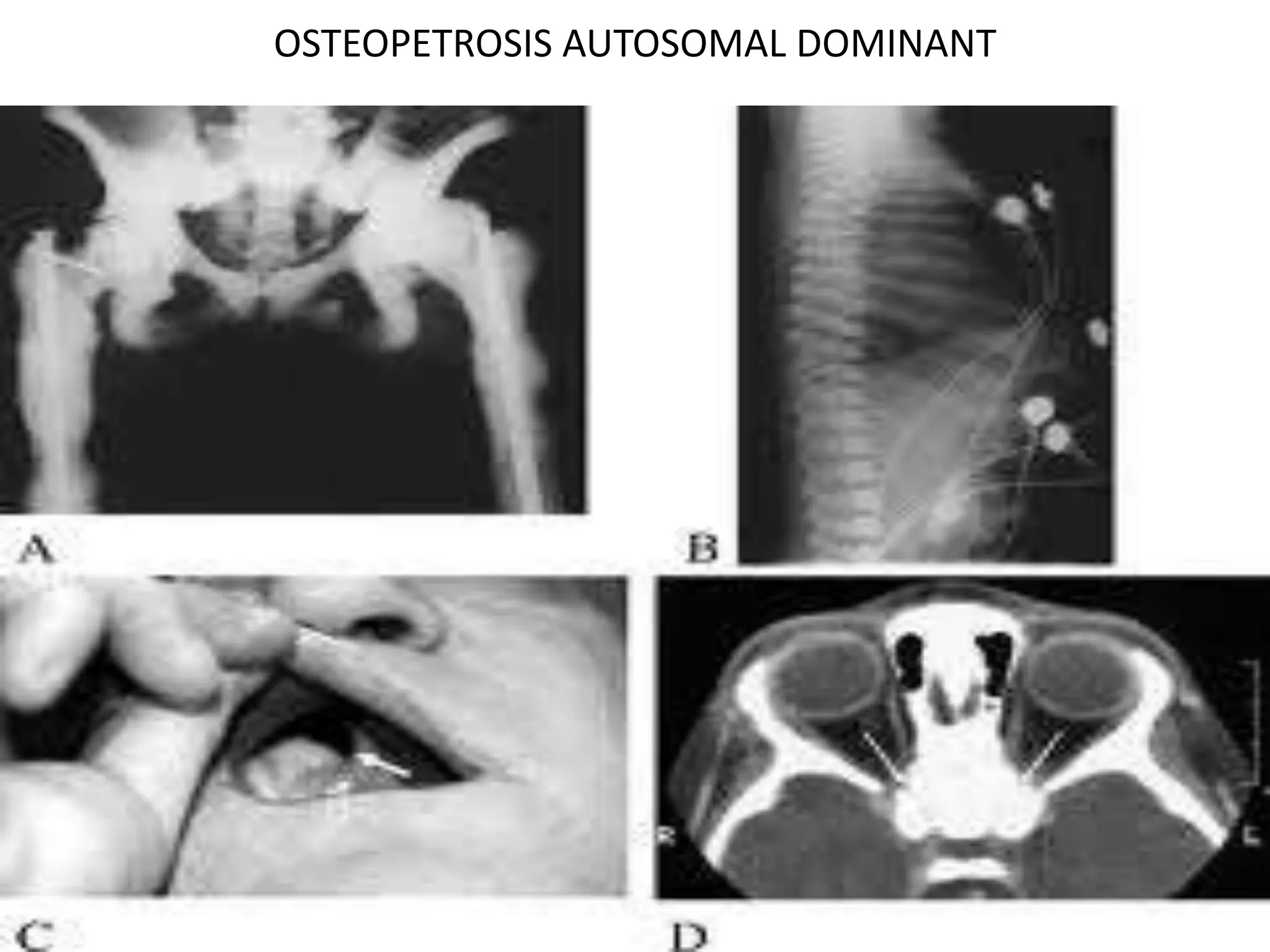 OSTEOPETROSIS AUTOSOMAL DOMINANT
 