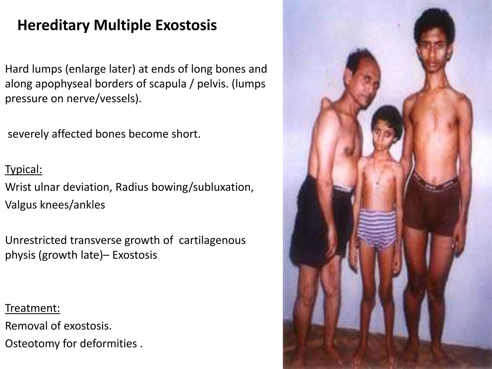 Hereditary Multiple Exostosis
Hard lumps (enlarge later) at ends of long bones and
along apophyseal borders of scapula / pelvis. (lumps
pressure on nerve/vessels).
severely affected bones become short.
Typical:
Wrist ulnar deviation, Radius bowing/subluxation,
Valgus knees/ankles
Unrestricted transverse growth of cartilagenous
physis (growth late)– Exostosis
Treatment:
Removal of exostosis.
Osteotomy for deformities .
 