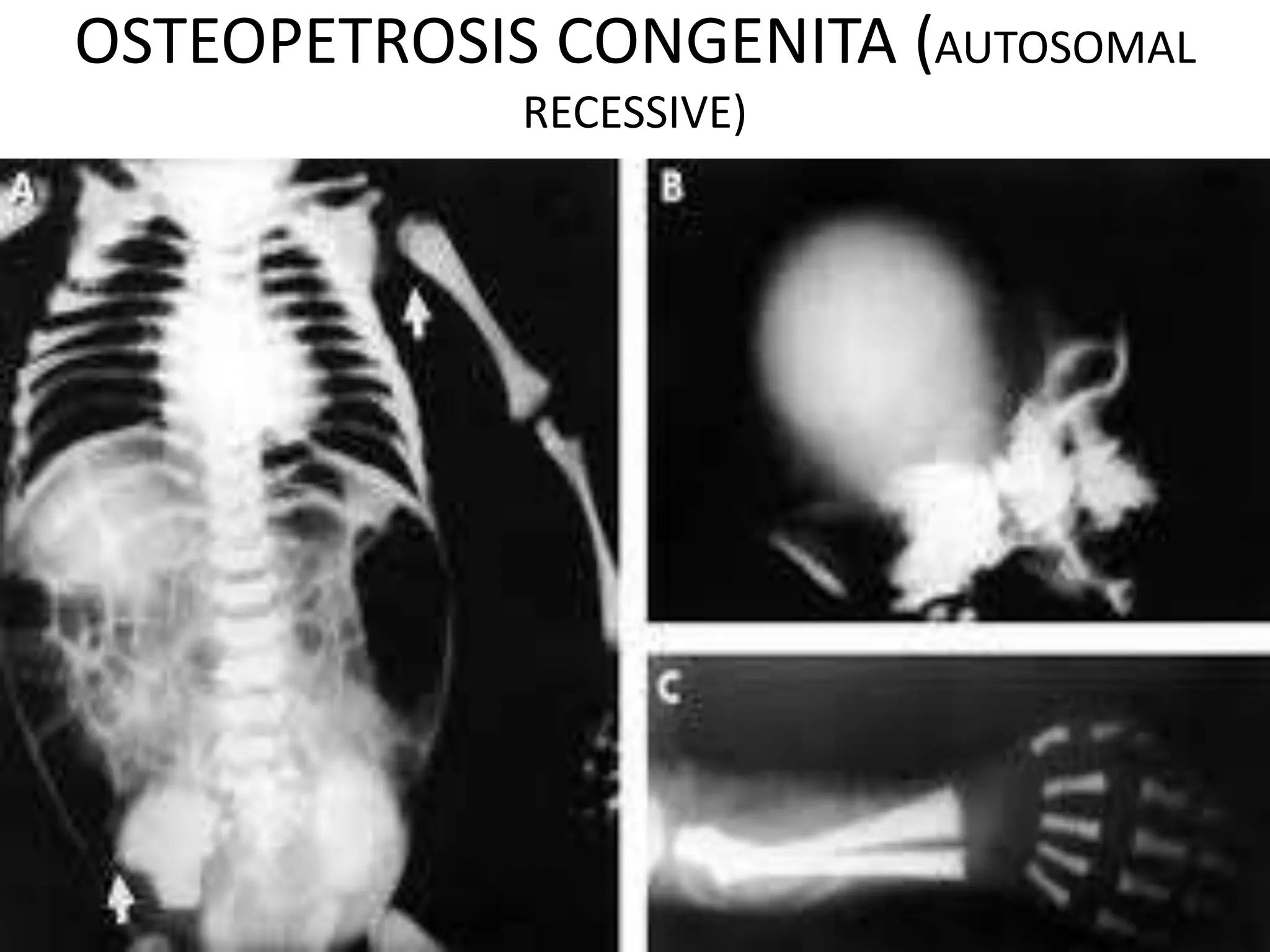OSTEOPETROSIS CONGENITA (AUTOSOMAL
RECESSIVE)
 