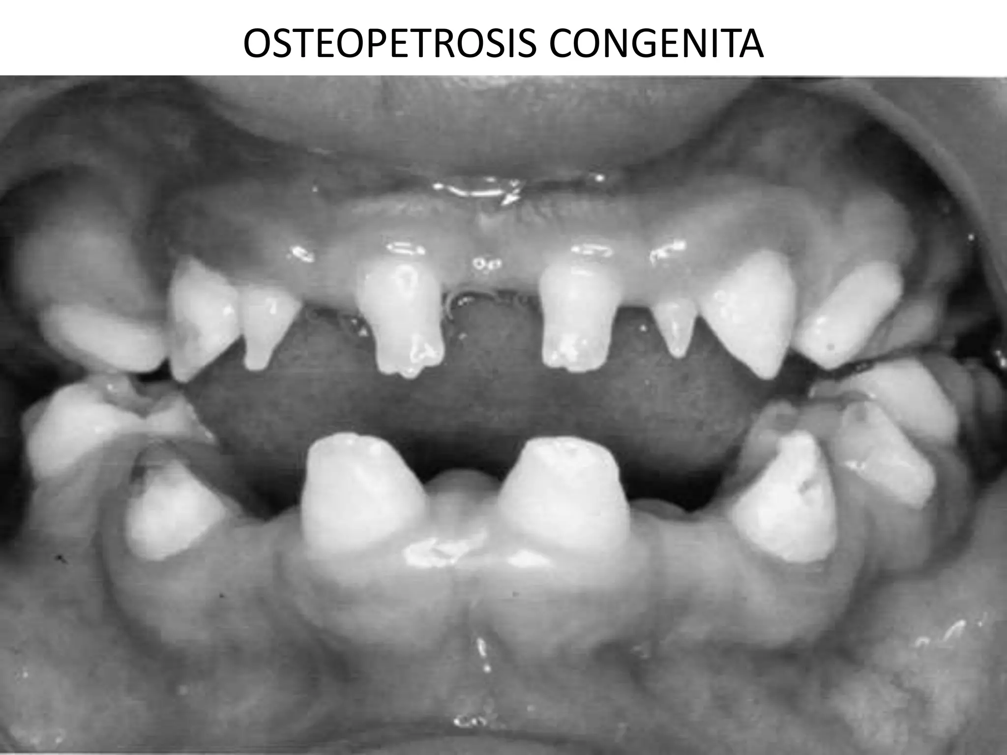OSTEOPETROSIS CONGENITA
 