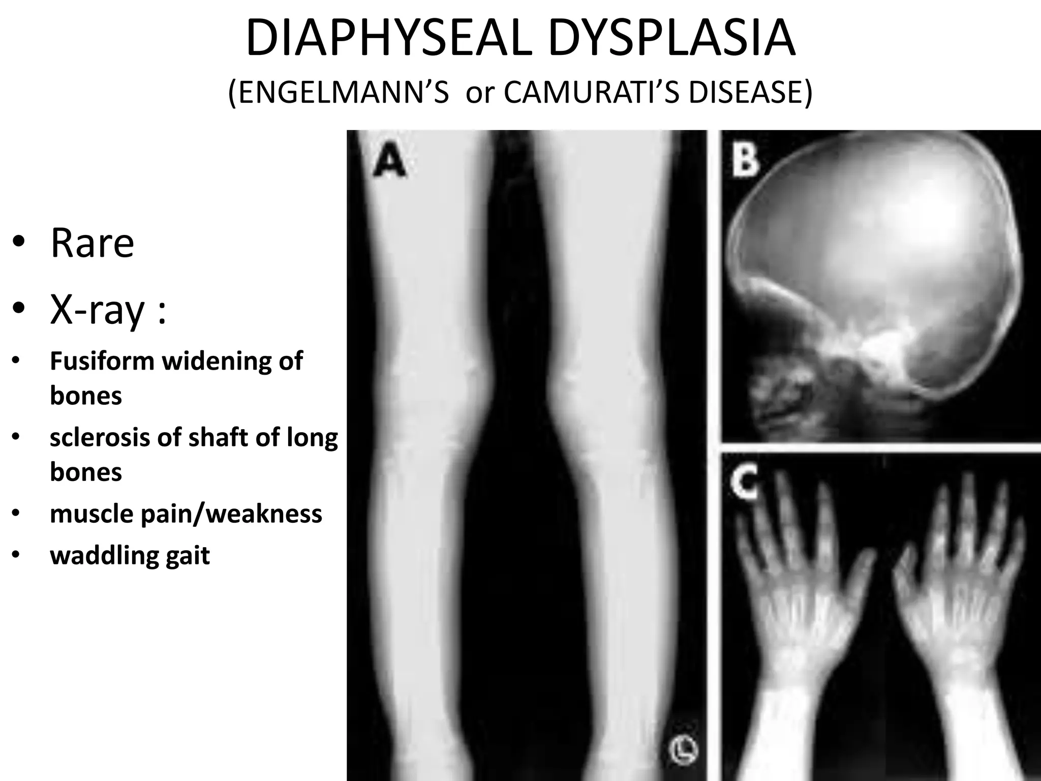 DIAPHYSEAL DYSPLASIA
(ENGELMANN’S or CAMURATI’S DISEASE)
• Rare
• X-ray :
• Fusiform widening of
bones
• sclerosis of shaft of long
bones
• muscle pain/weakness
• waddling gait
 