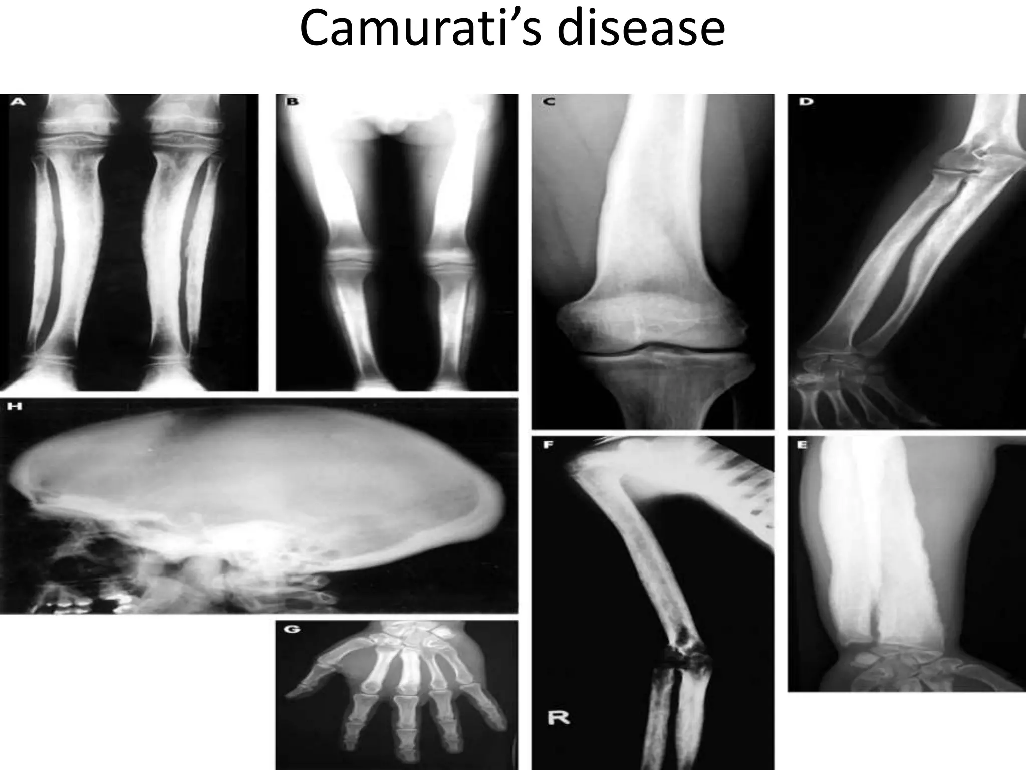 Camurati’s disease
 