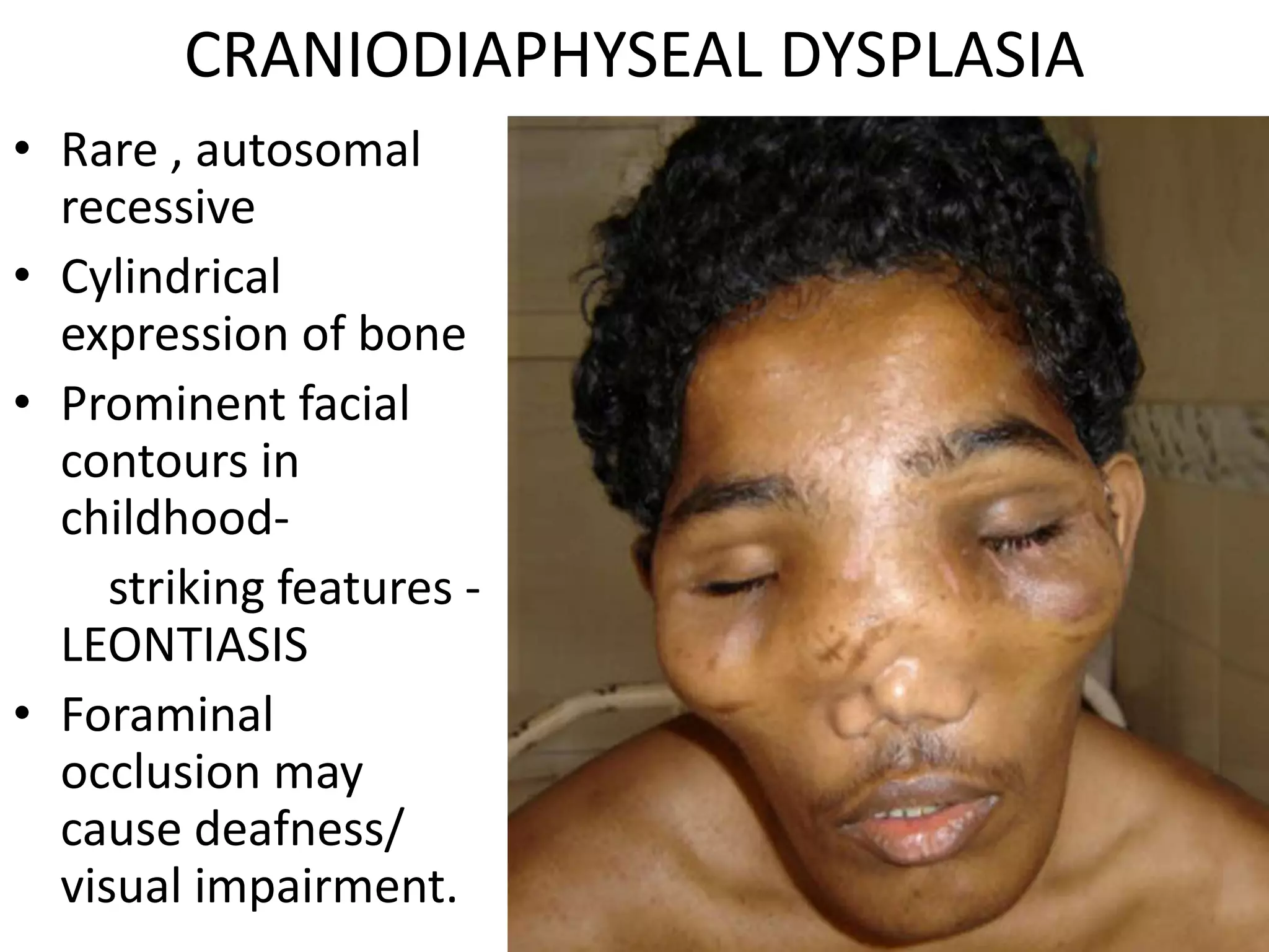 CRANIODIAPHYSEAL DYSPLASIA
• Rare , autosomal
recessive
• Cylindrical
expression of bone
• Prominent facial
contours in
childhood-
striking features -
LEONTIASIS
• Foraminal
occlusion may
cause deafness/
visual impairment.
 