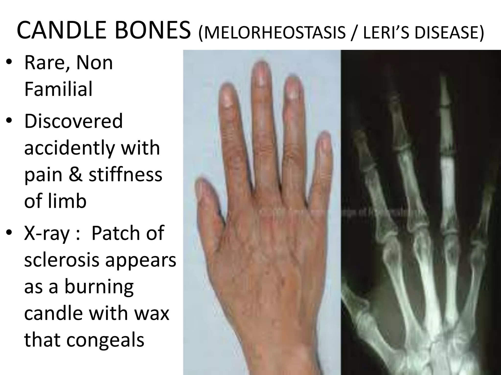 CANDLE BONES (MELORHEOSTASIS / LERI’S DISEASE)
• Rare, Non
Familial
• Discovered
accidently with
pain & stiffness
of limb
• X-ray : Patch of
sclerosis appears
as a burning
candle with wax
that congeals
 