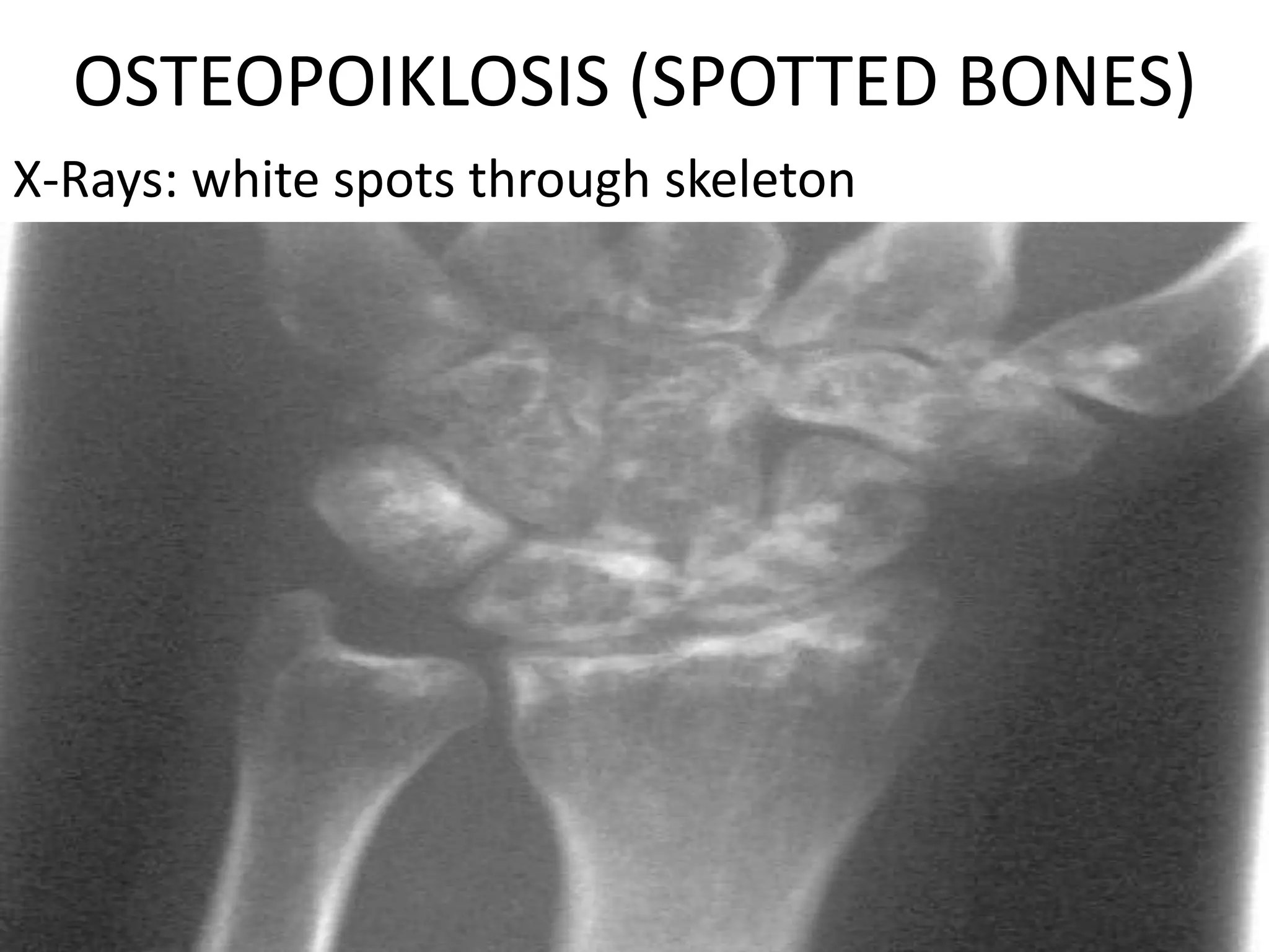OSTEOPOIKLOSIS (SPOTTED BONES)
X-Rays: white spots through skeleton
 