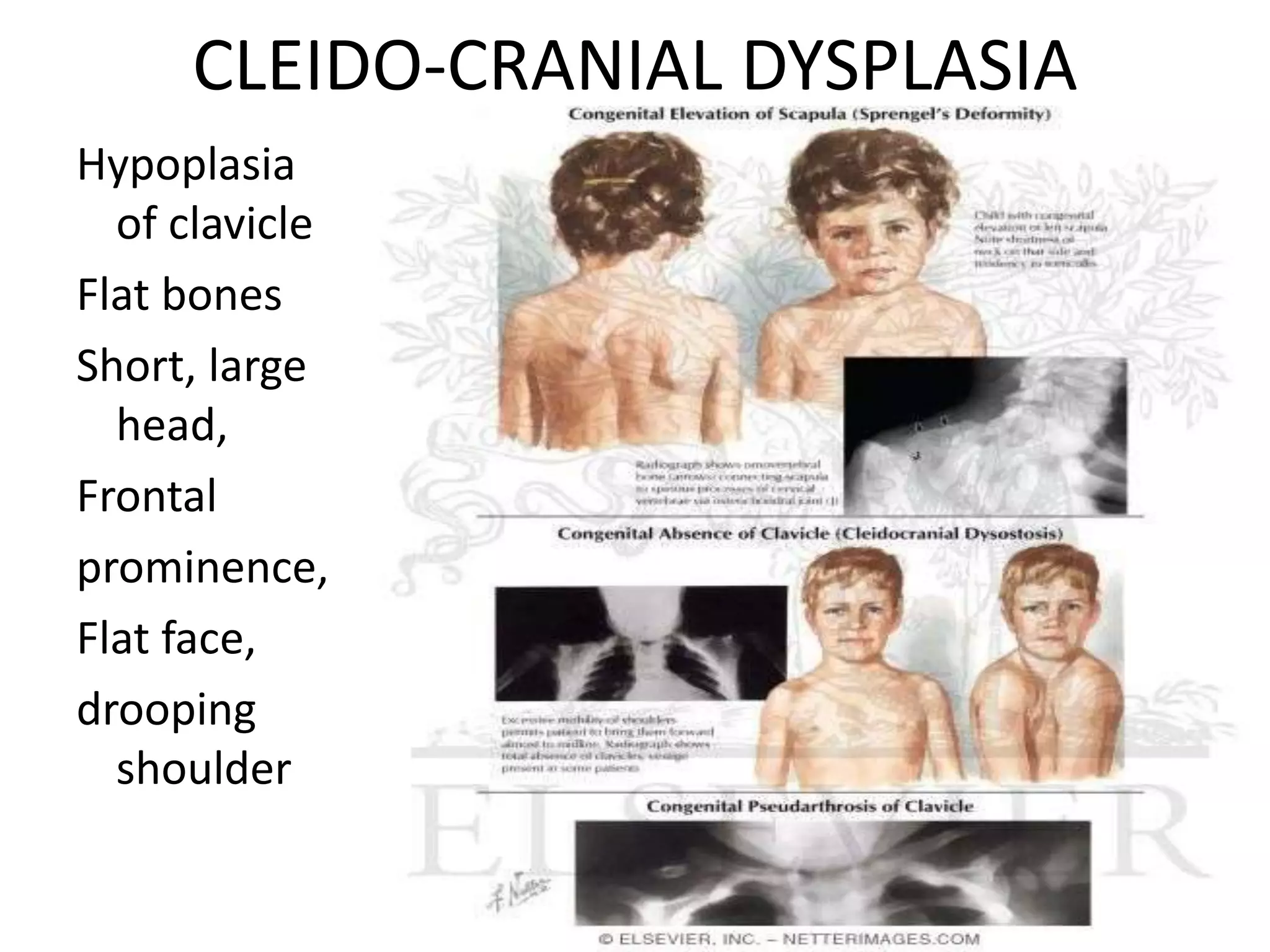 CLEIDO-CRANIAL DYSPLASIA
Hypoplasia
of clavicle
Flat bones
Short, large
head,
Frontal
prominence,
Flat face,
drooping
shoulder
 