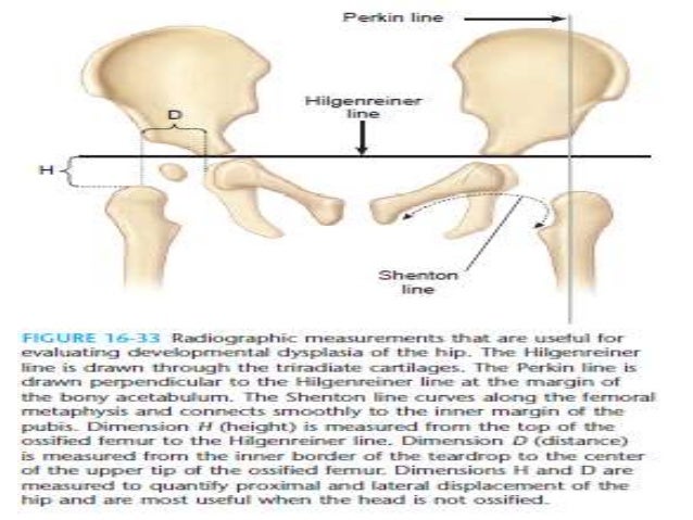 Developmental displasia of hip