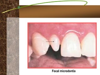 Micro Tooth Developmental Disturbances.ppt
