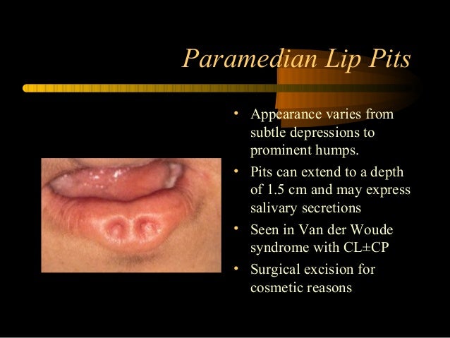 developmental disorders of orofacial structures dental bilateral cleft lip