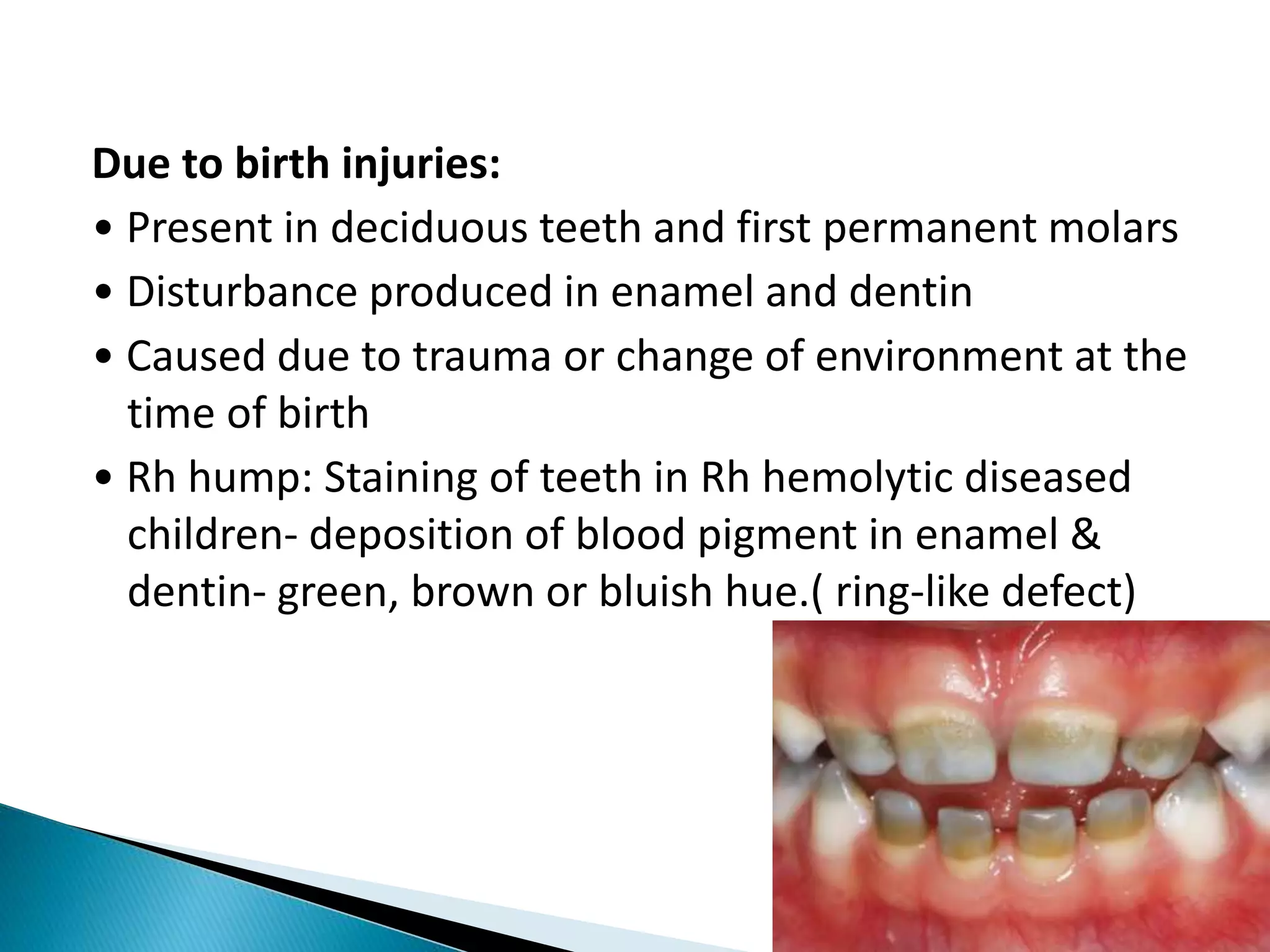 Due to birth injuries:
• Present in deciduous teeth and first permanent molars
• Disturbance produced in enamel and dentin
• Caused due to trauma or change of environment at the
time of birth
• Rh hump: Staining of teeth in Rh hemolytic diseased
children- deposition of blood pigment in enamel &
dentin- green, brown or bluish hue.( ring-like defect)
 