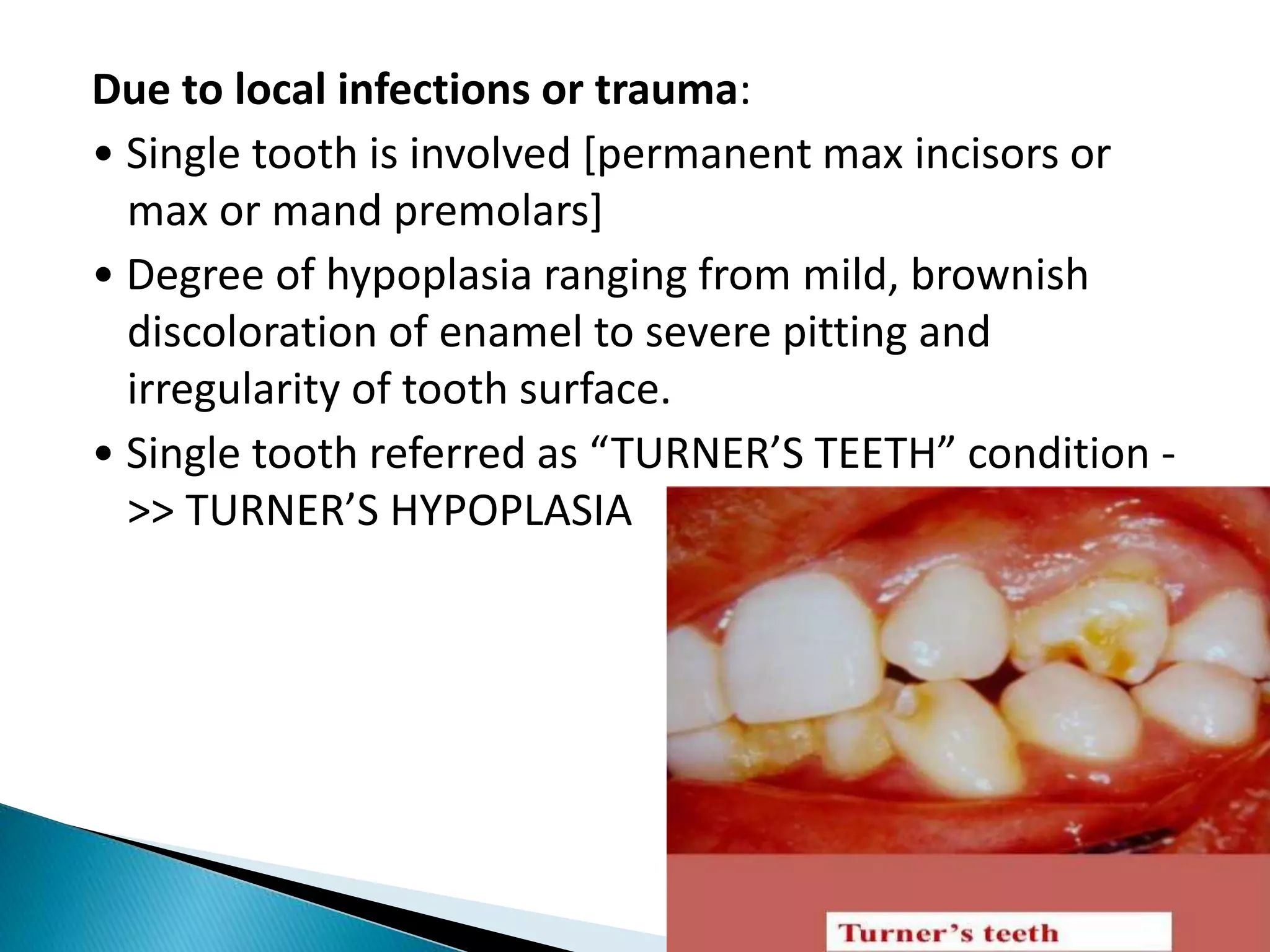 Due to local infections or trauma:
• Single tooth is involved [permanent max incisors or
max or mand premolars]
• Degree of hypoplasia ranging from mild, brownish
discoloration of enamel to severe pitting and
irregularity of tooth surface.
• Single tooth referred as “TURNER’S TEETH” condition -
>> TURNER’S HYPOPLASIA
 