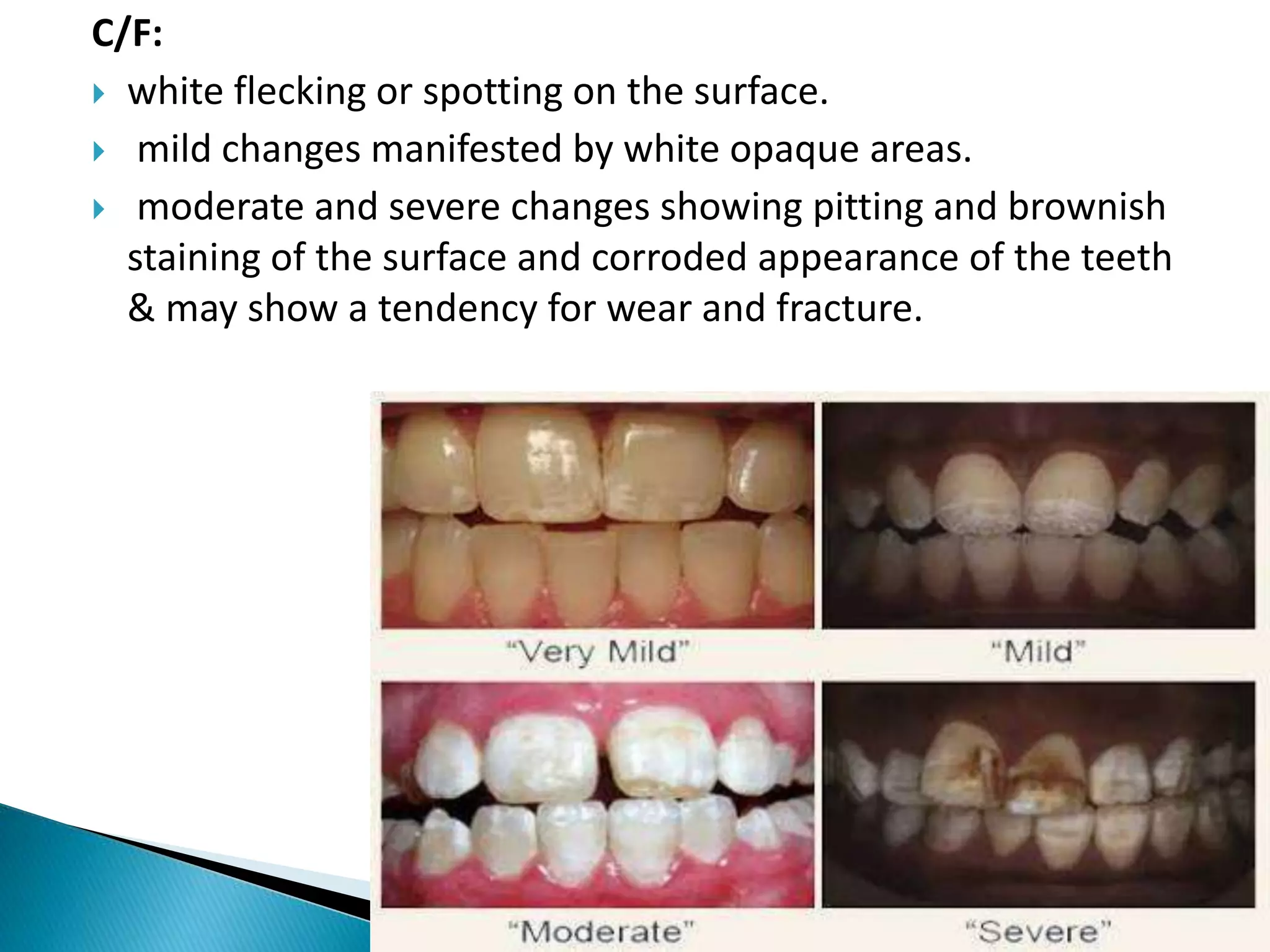 C/F:
 white flecking or spotting on the surface.
 mild changes manifested by white opaque areas.
 moderate and severe changes showing pitting and brownish
staining of the surface and corroded appearance of the teeth
& may show a tendency for wear and fracture.
 