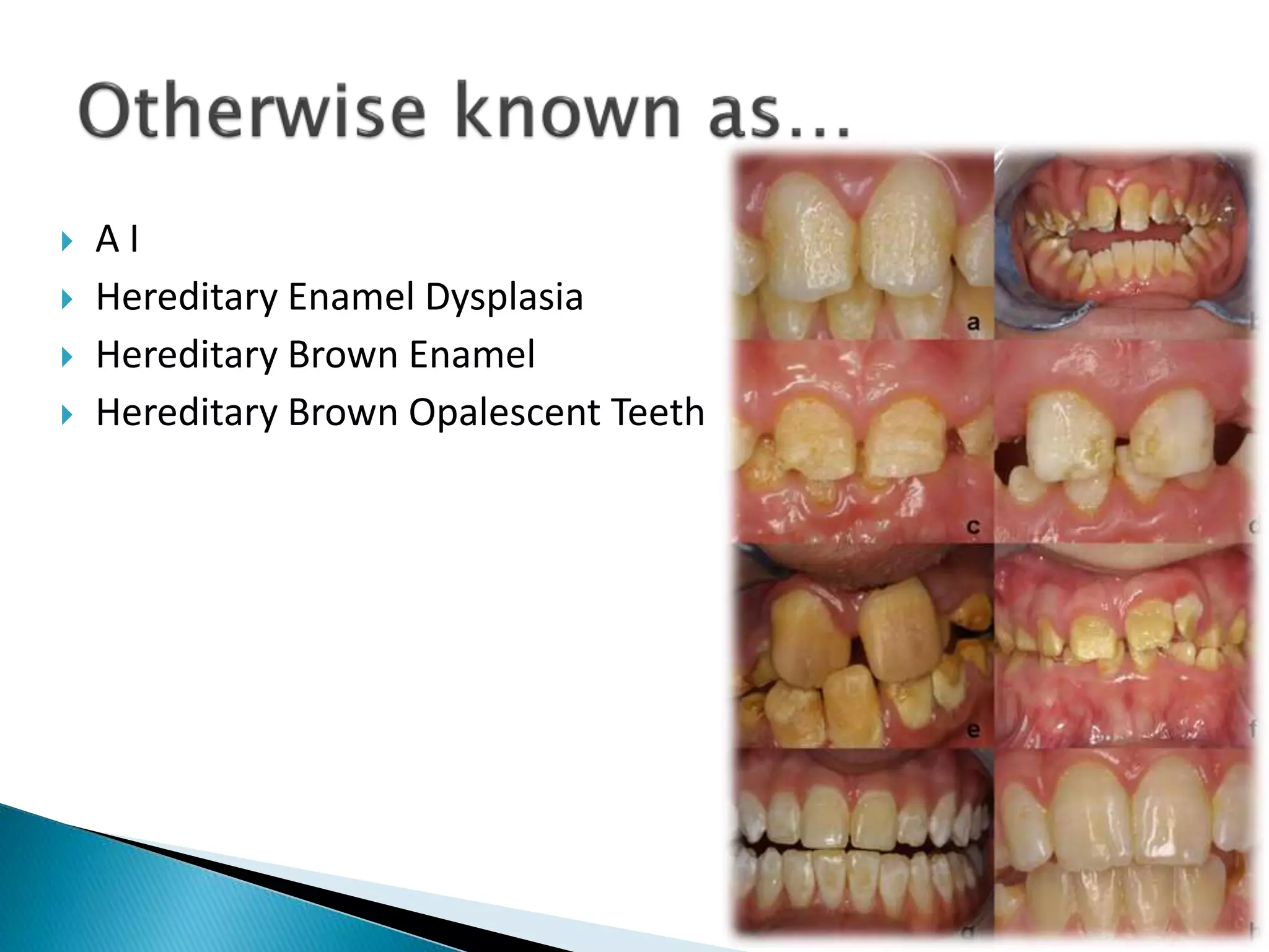  A I
 Hereditary Enamel Dysplasia
 Hereditary Brown Enamel
 Hereditary Brown Opalescent Teeth
 