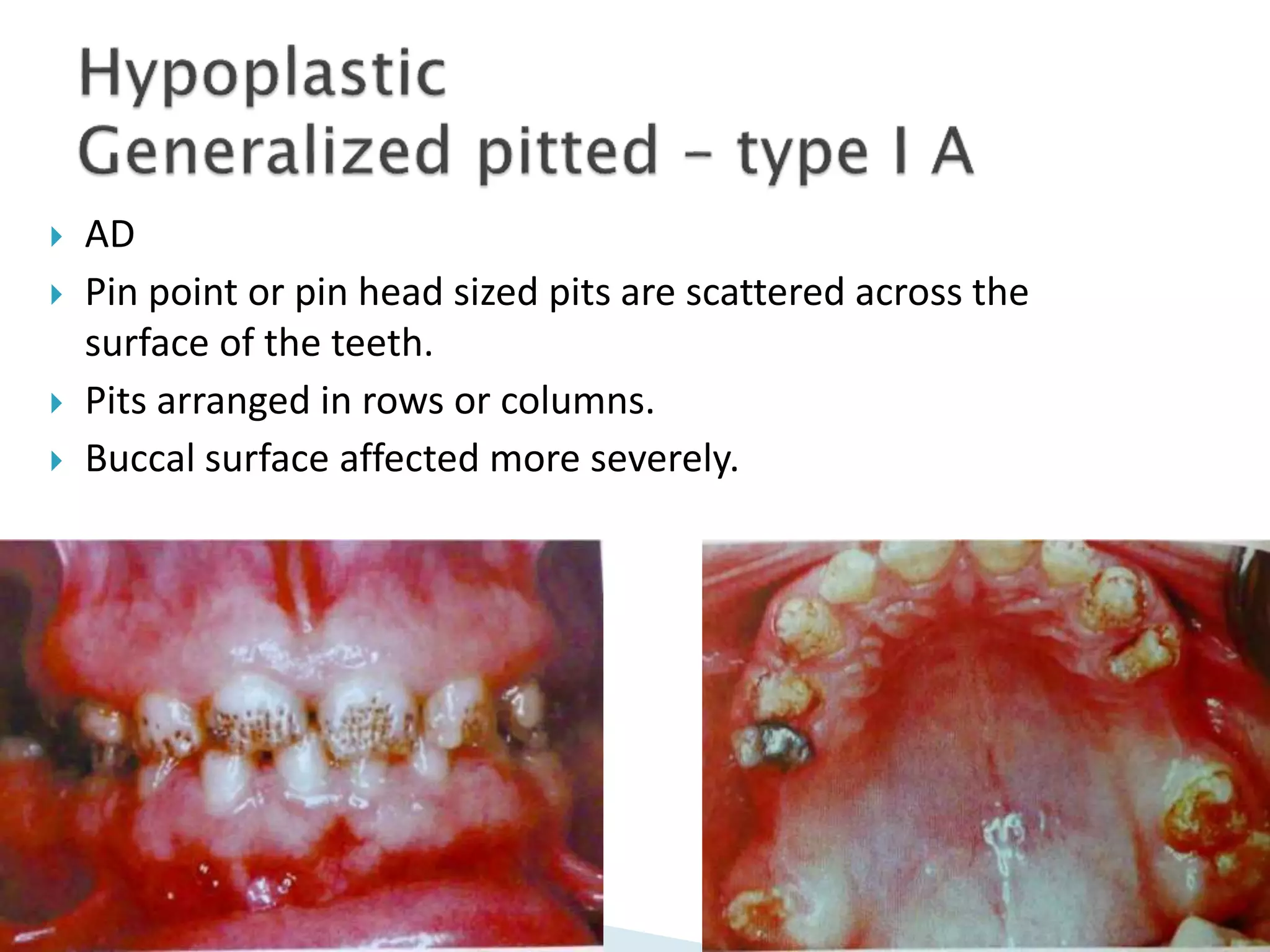  AD
 Pin point or pin head sized pits are scattered across the
surface of the teeth.
 Pits arranged in rows or columns.
 Buccal surface affected more severely.
 