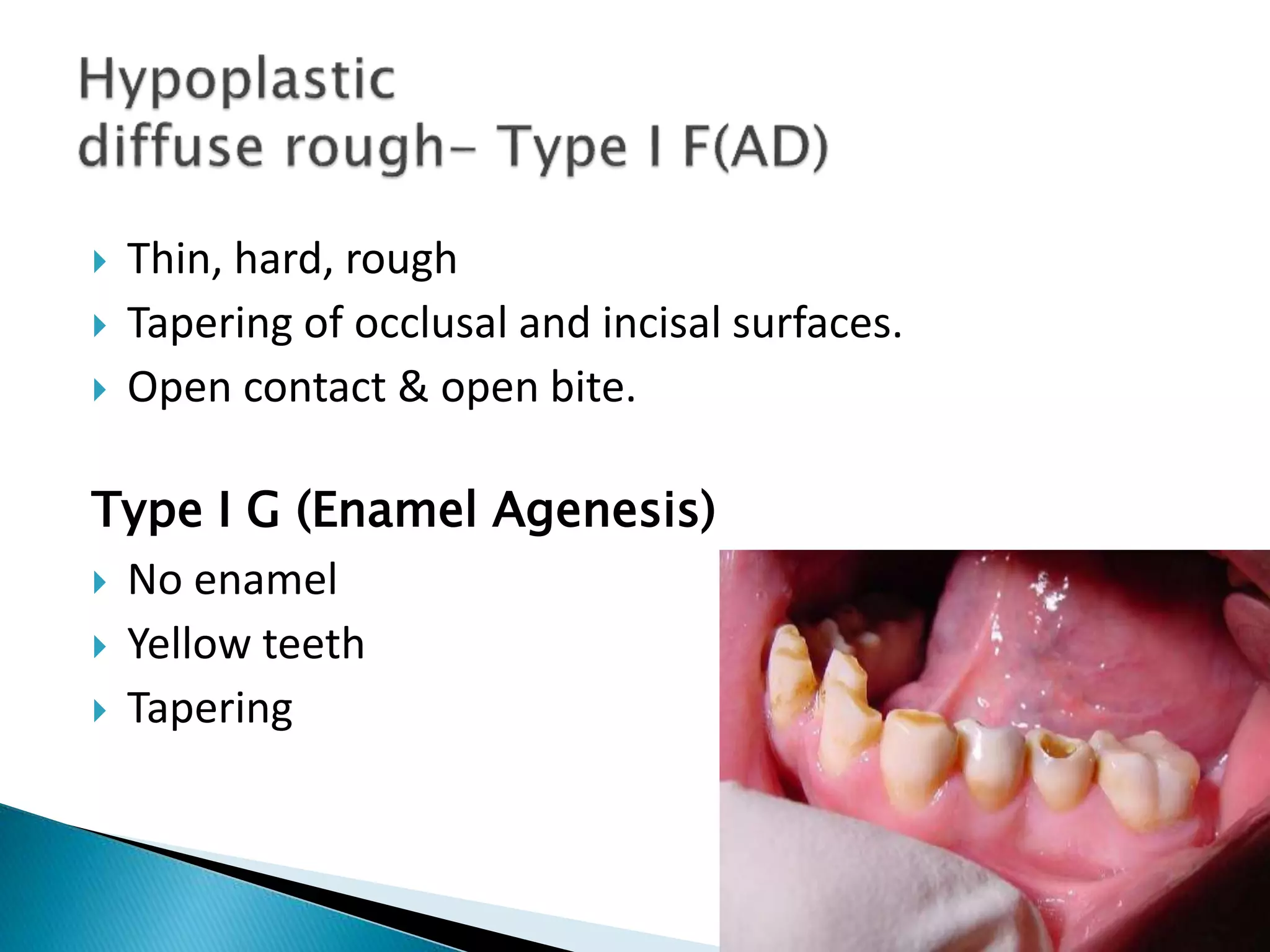  Thin, hard, rough
 Tapering of occlusal and incisal surfaces.
 Open contact & open bite.
Type I G (Enamel Agenesis)
 No enamel
 Yellow teeth
 Tapering
 