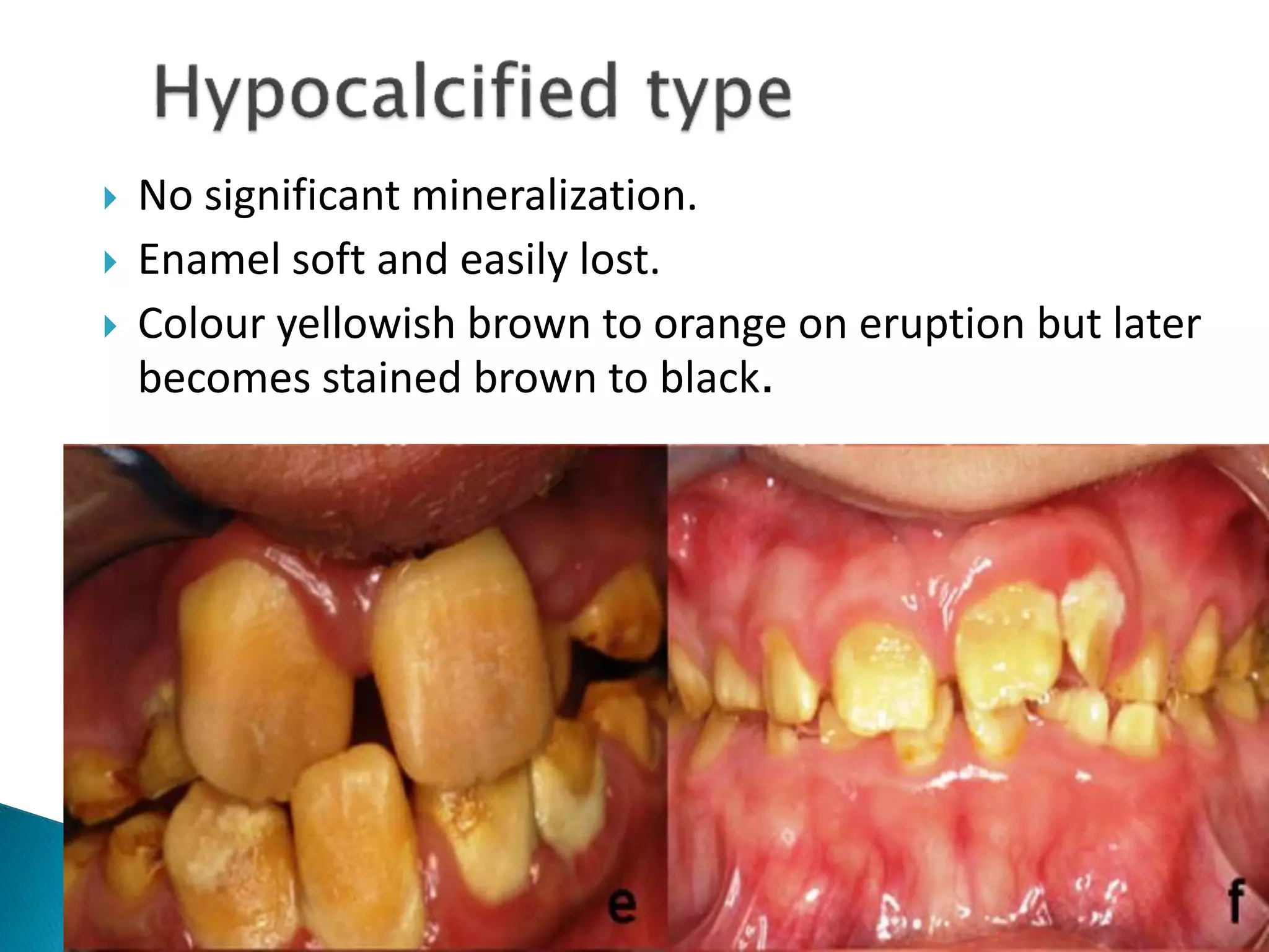  No significant mineralization.
 Enamel soft and easily lost.
 Colour yellowish brown to orange on eruption but later
becomes stained brown to black.
 