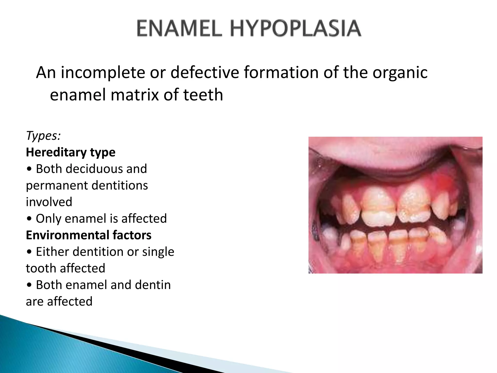 An incomplete or defective formation of the organic
enamel matrix of teeth
Types:
Hereditary type
• Both deciduous and
permanent dentitions
involved
• Only enamel is affected
Environmental factors
• Either dentition or single
tooth affected
• Both enamel and dentin
are affected
 