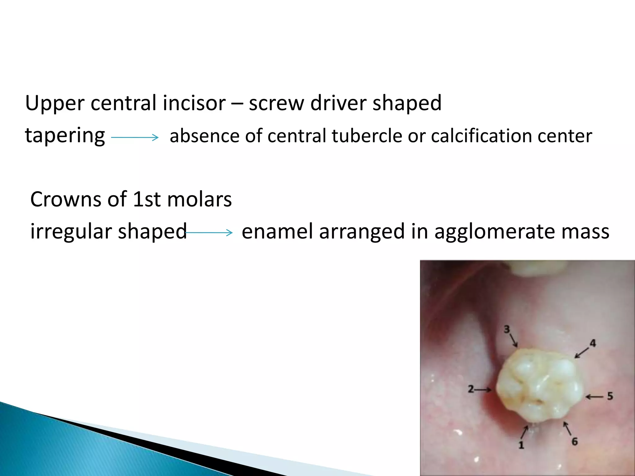 Upper central incisor – screw driver shaped
tapering absence of central tubercle or calcification center
Crowns of 1st molars
irregular shaped enamel arranged in agglomerate mass
 