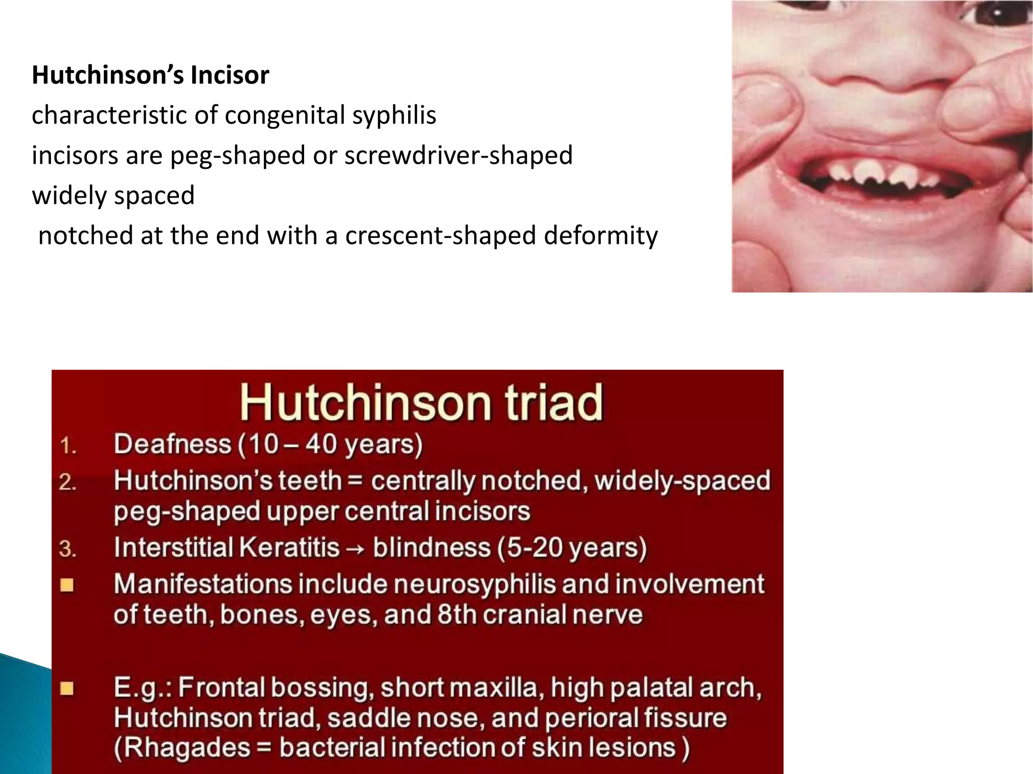 Hutchinson’s Incisor
characteristic of congenital syphilis
incisors are peg-shaped or screwdriver-shaped
widely spaced
notched at the end with a crescent-shaped deformity
 