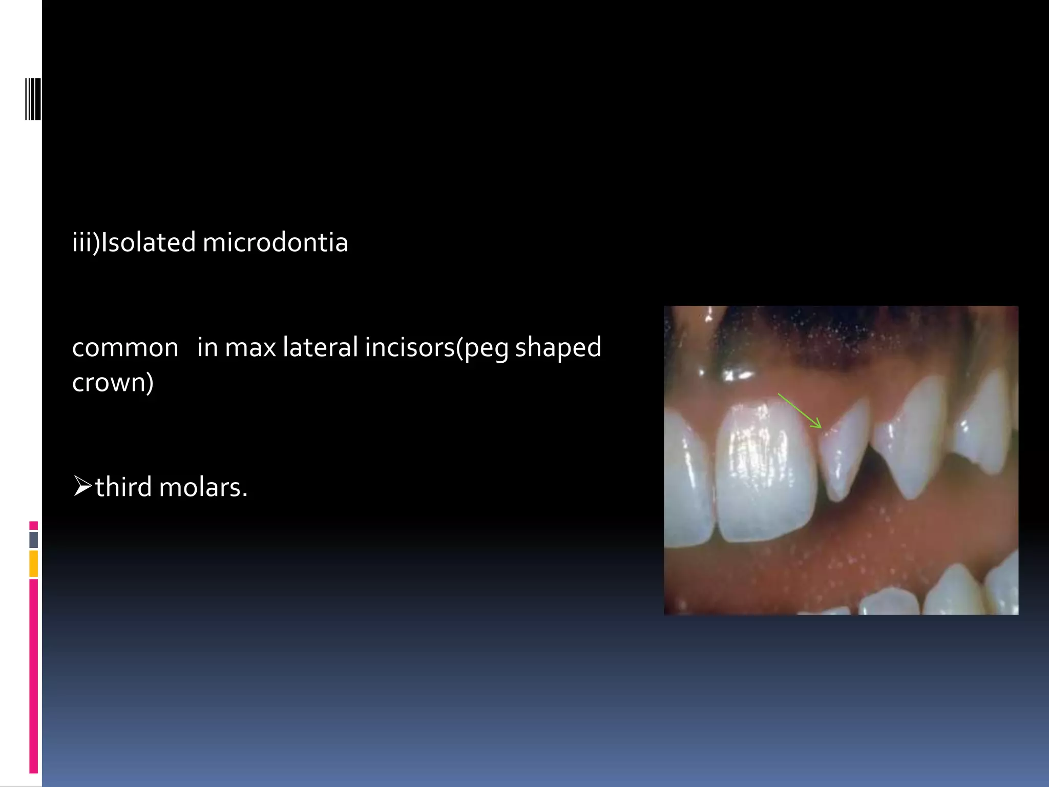 iii)Isolated microdontia
common in max lateral incisors(peg shaped
crown)
third molars.
 