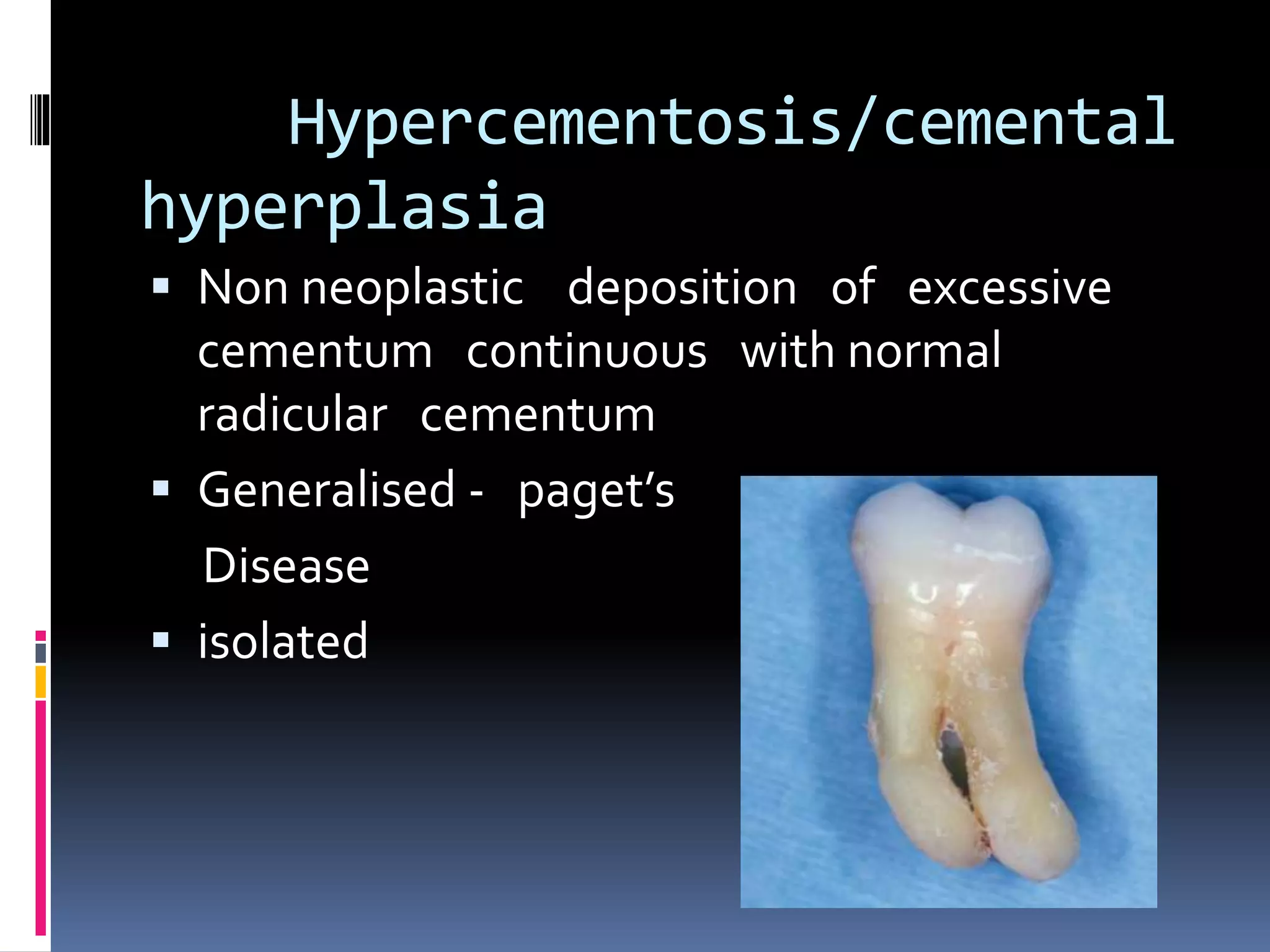 Hypercementosis/cemental
hyperplasia
 Non neoplastic deposition of excessive
cementum continuous with normal
radicular cementum
 Generalised - paget’s
Disease
 isolated
 