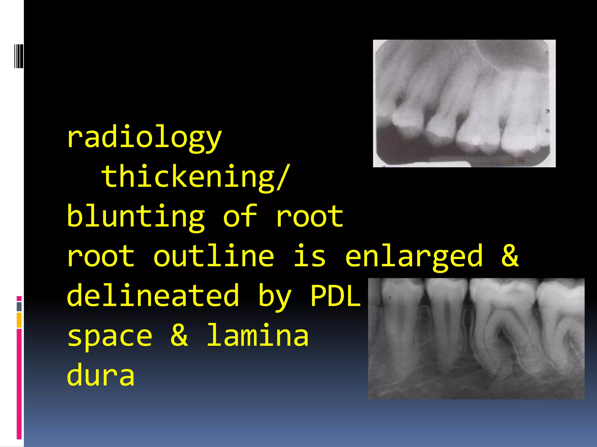 radiology
thickening/
blunting of root
root outline is enlarged &
delineated by PDL
space & lamina
dura
 