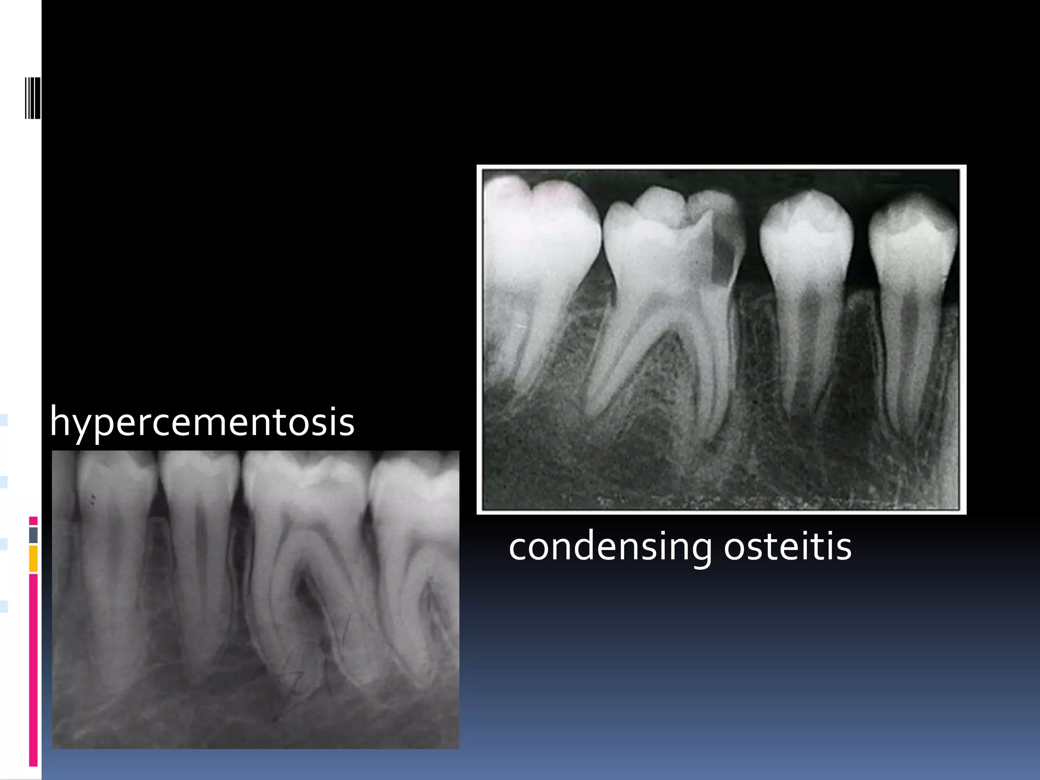  hypercementosis

 condensing osteitis

 
