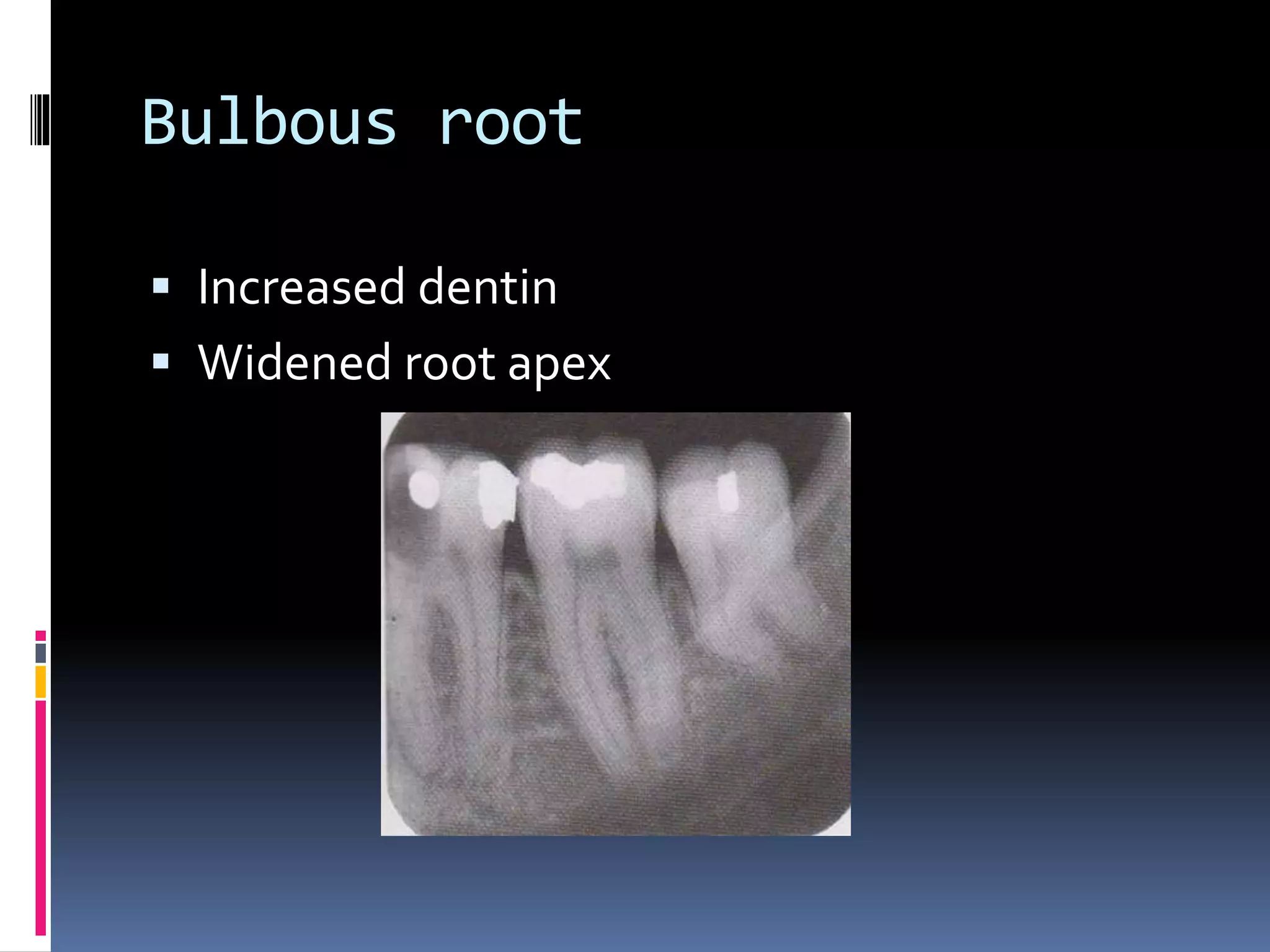 Bulbous root
 Increased dentin
 Widened root apex
 