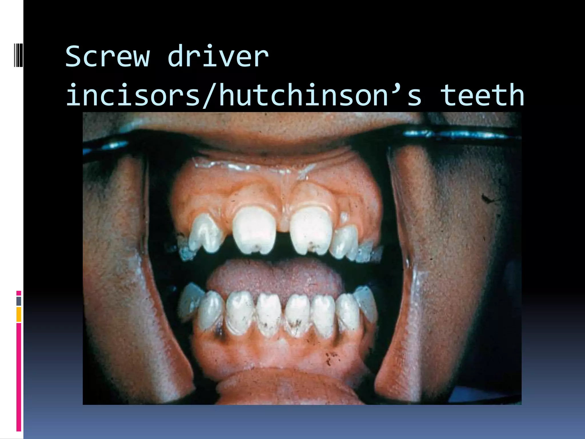 Screw driver
incisors/hutchinson’s teeth
 