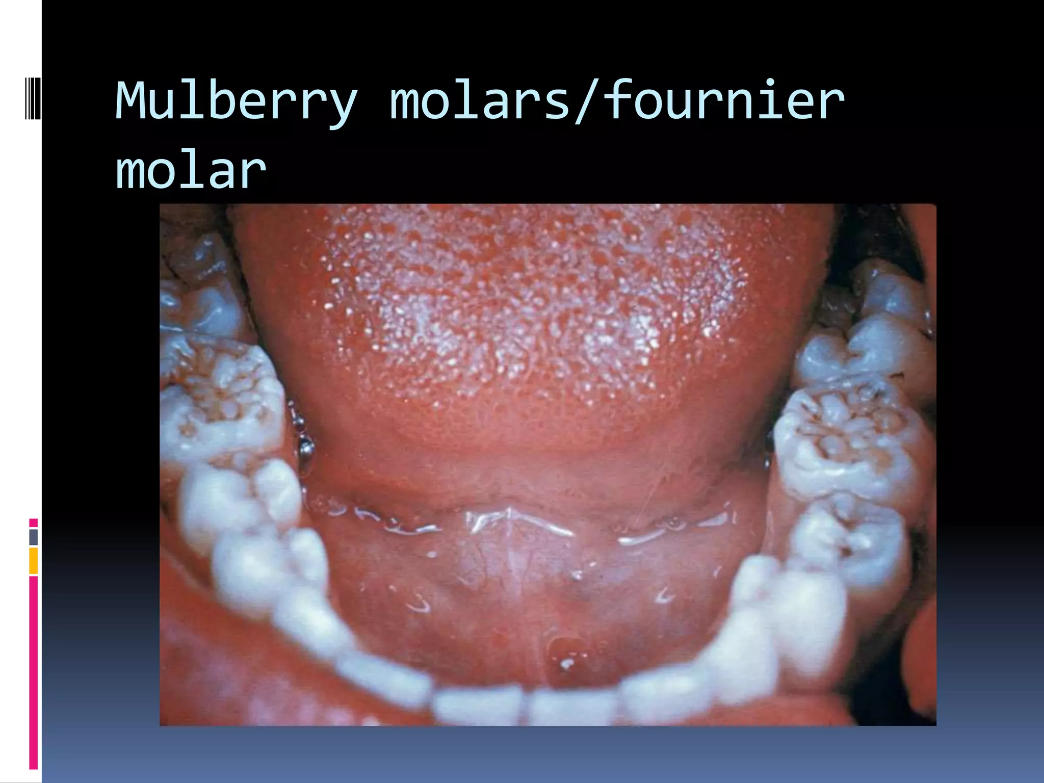 Mulberry molars/fournier
molar
 